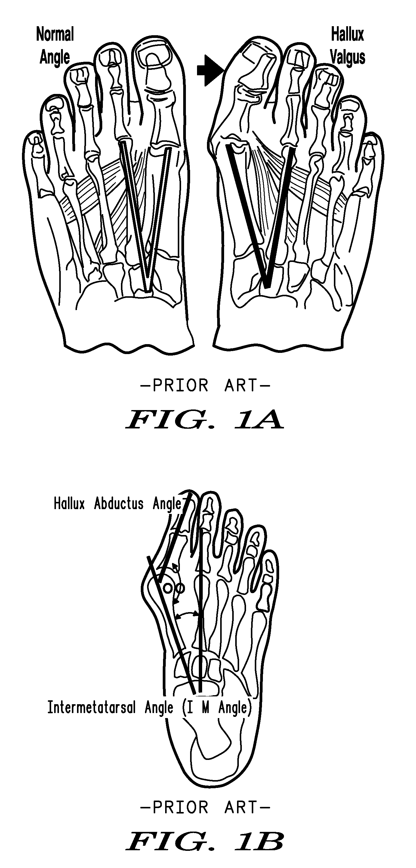 Methods and devices for treating hallux valgus