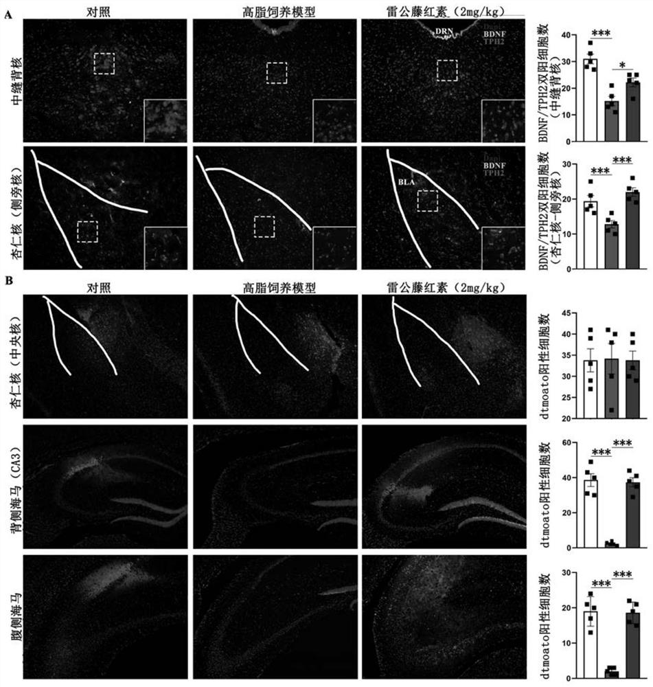 Applications of tripterine in preparation of drugs for treating complex refractory depression