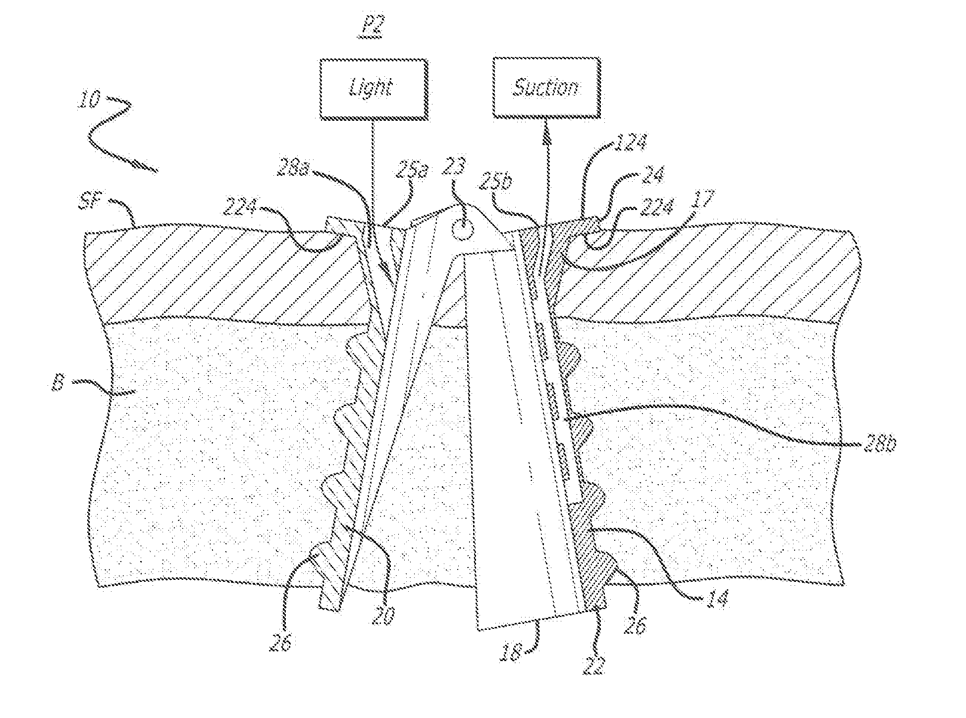 Surgical cannula with channels for irrigation and suction