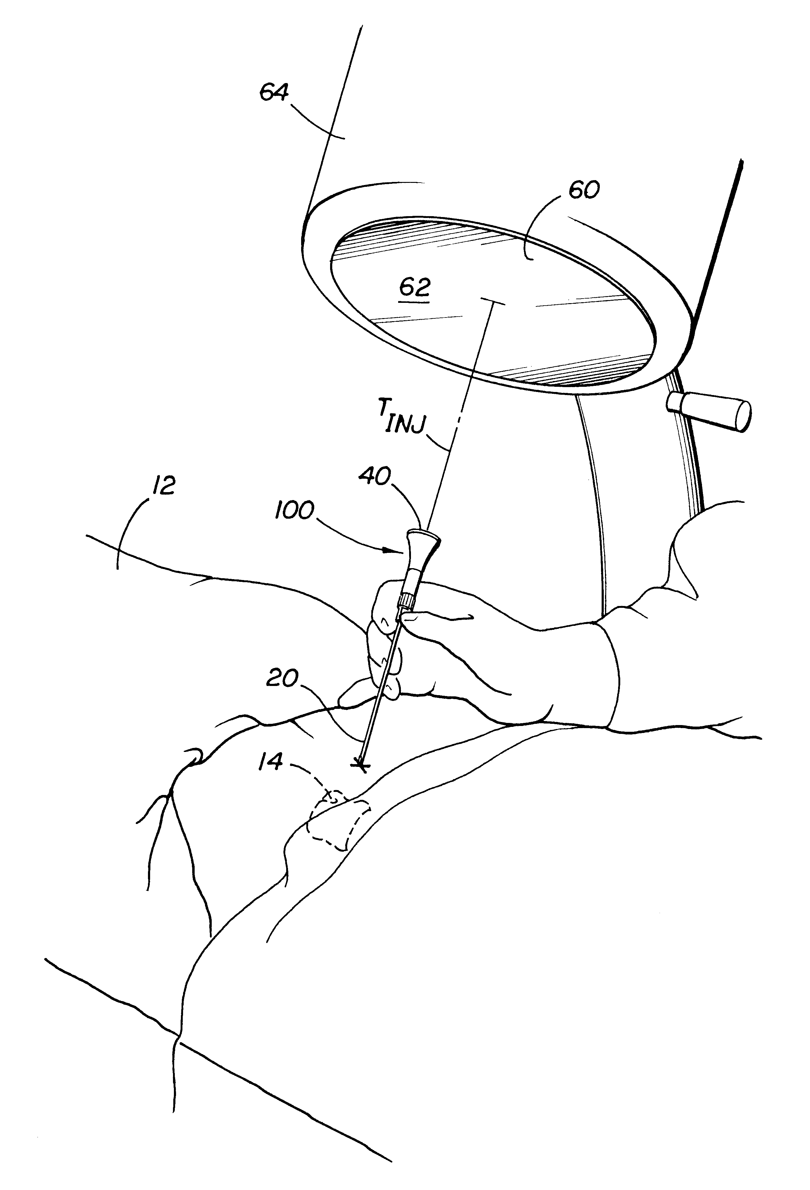 Percutaneous needle alignment system and associated method