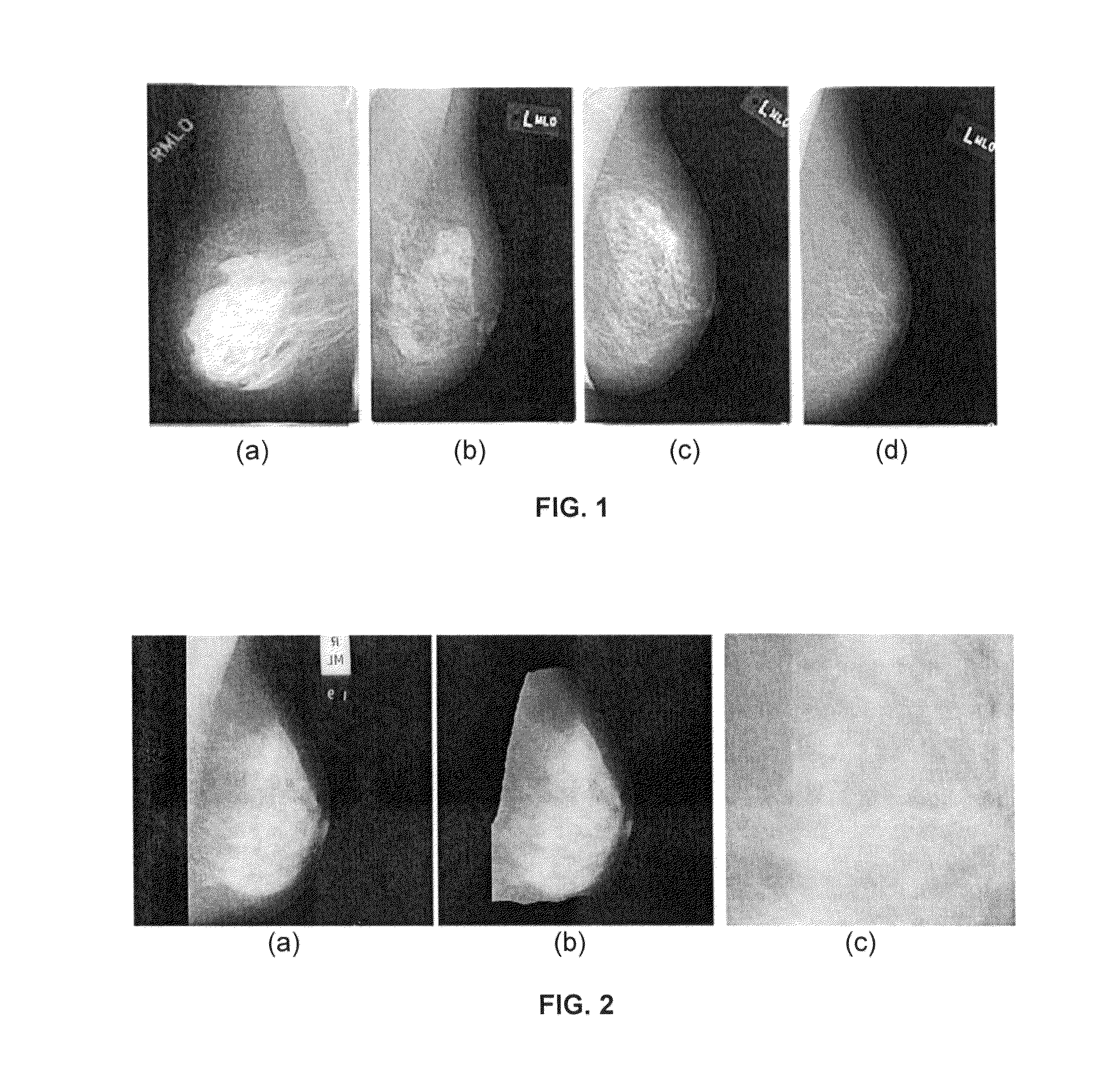 Method, system and computer program product for breast density classification using fisher discrimination