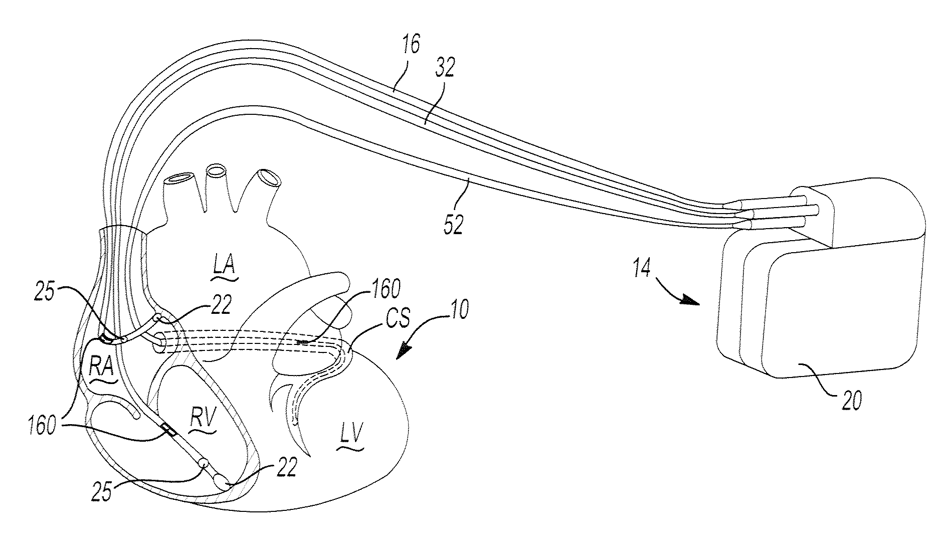 Chronically-implantable active fixation medical electrical leads and related methods for non-fluoroscopic implantation