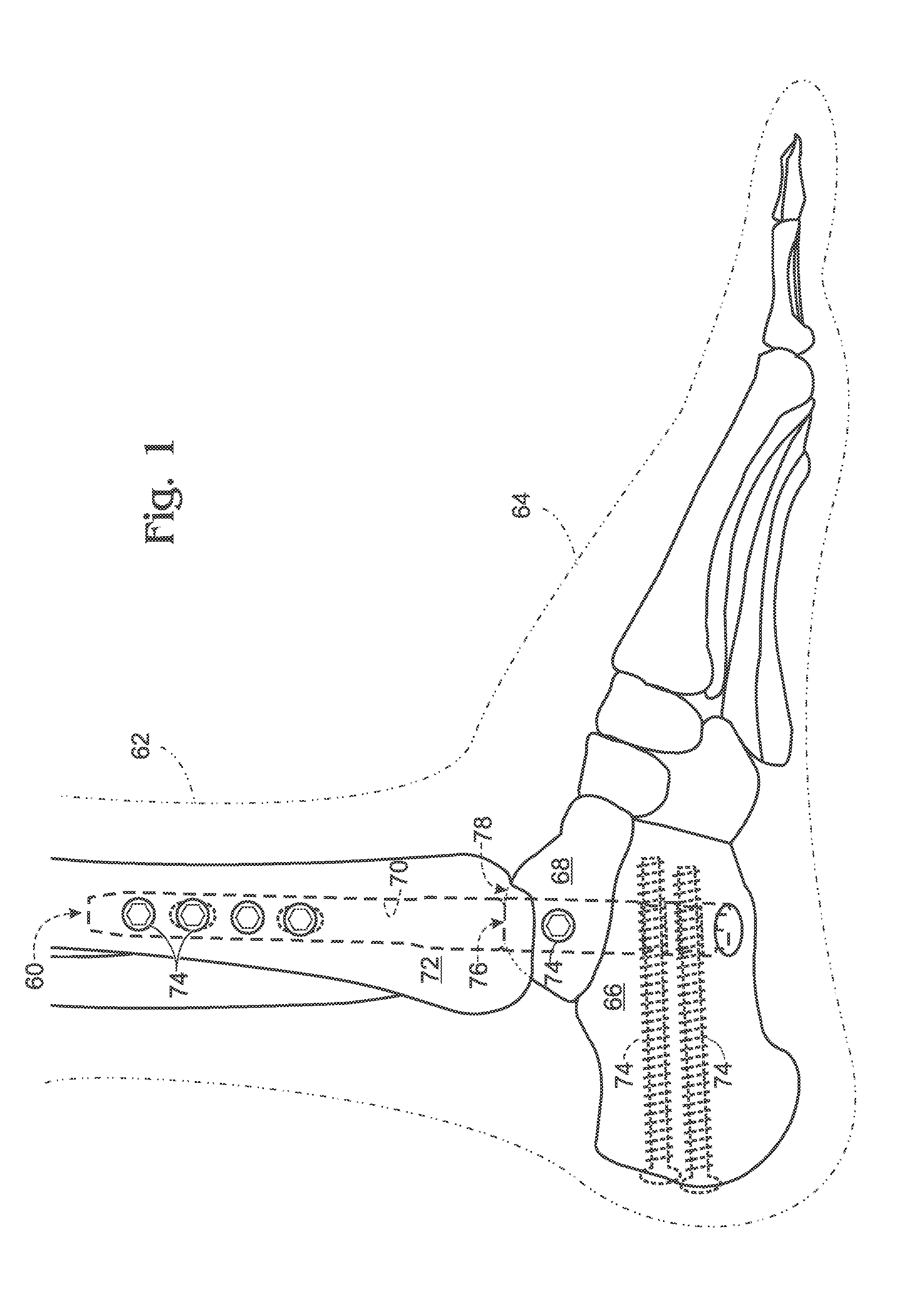 Articulated intramedullary nail