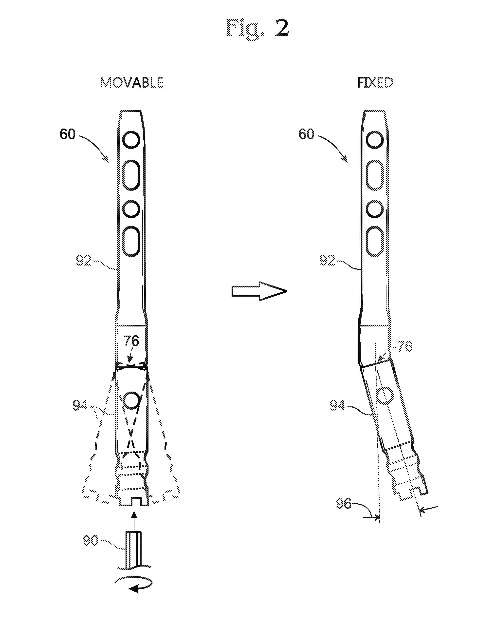 Articulated intramedullary nail