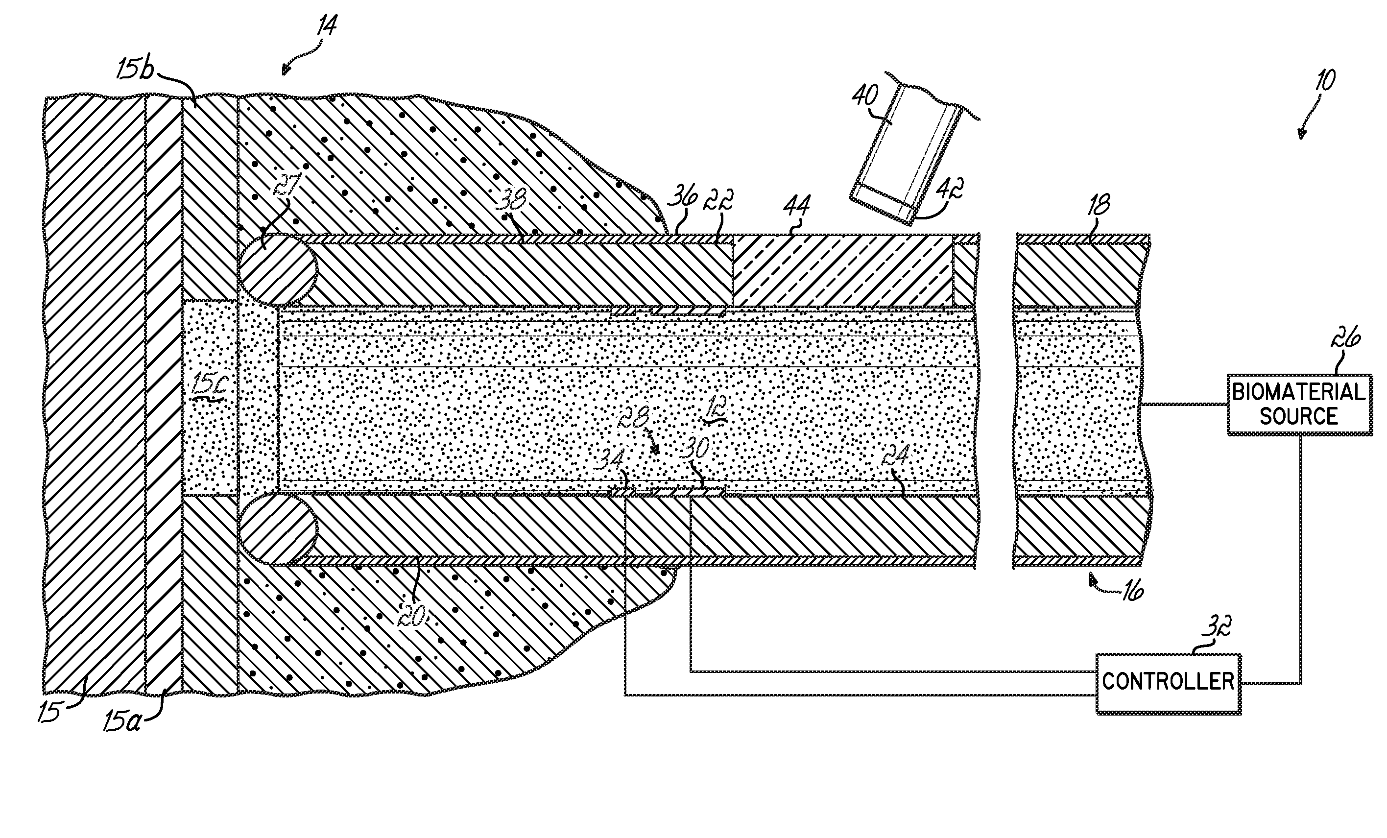 Apparatus and method for delivering a biocompatible material to a surgical site