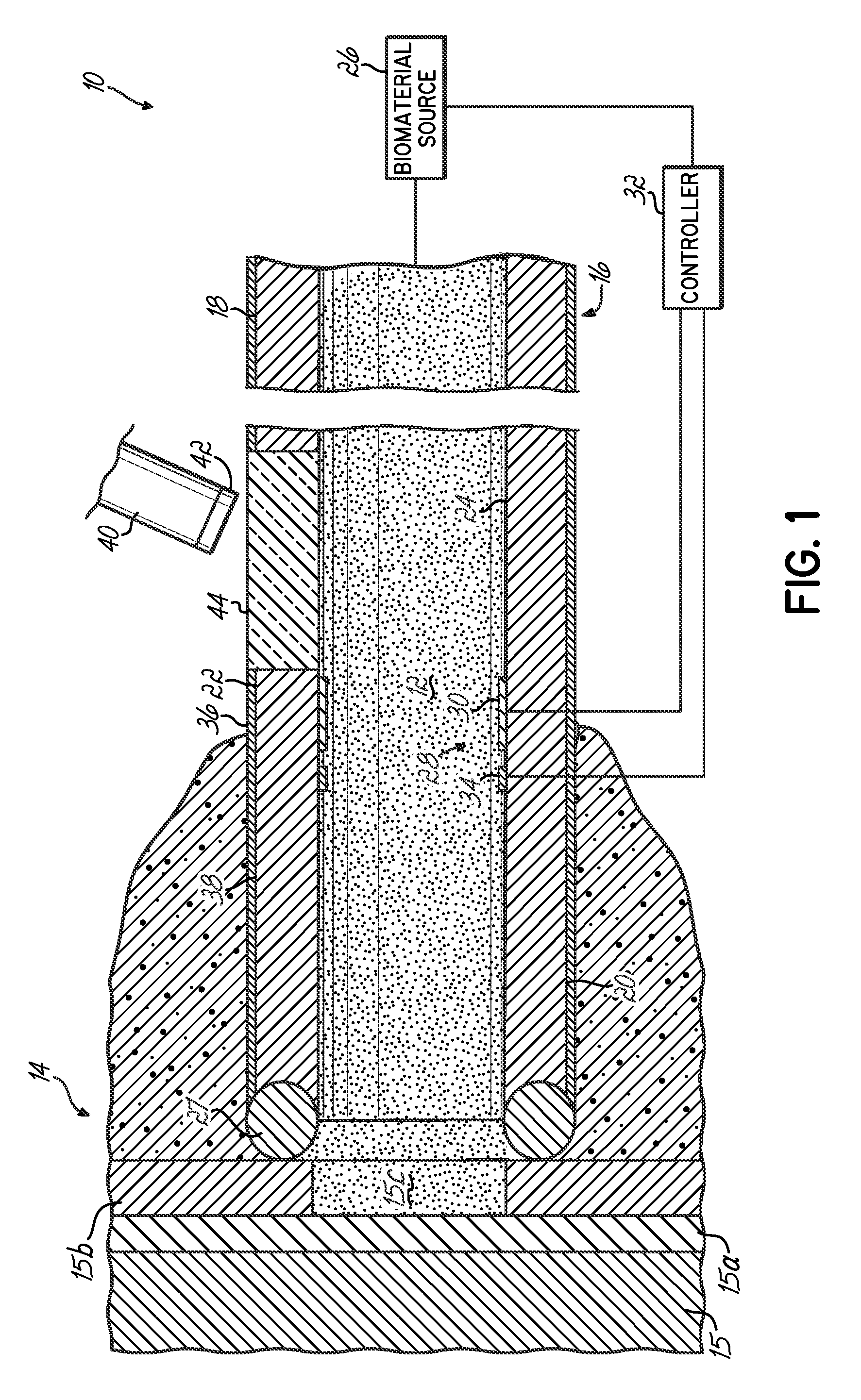 Apparatus and method for delivering a biocompatible material to a surgical site