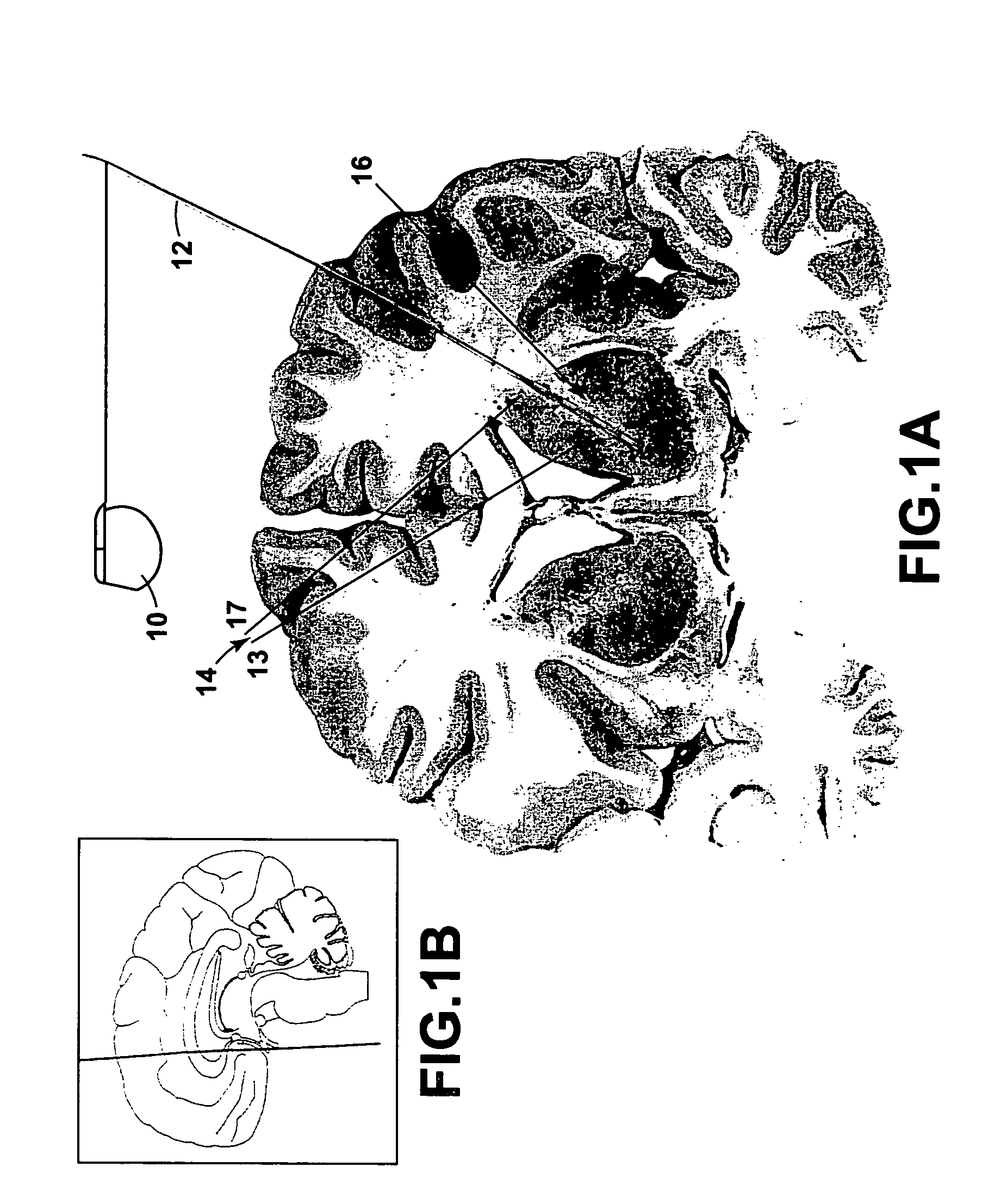 Method for treating obsessive-compulsive disorder with electrical stimulation of the brain internal capsule