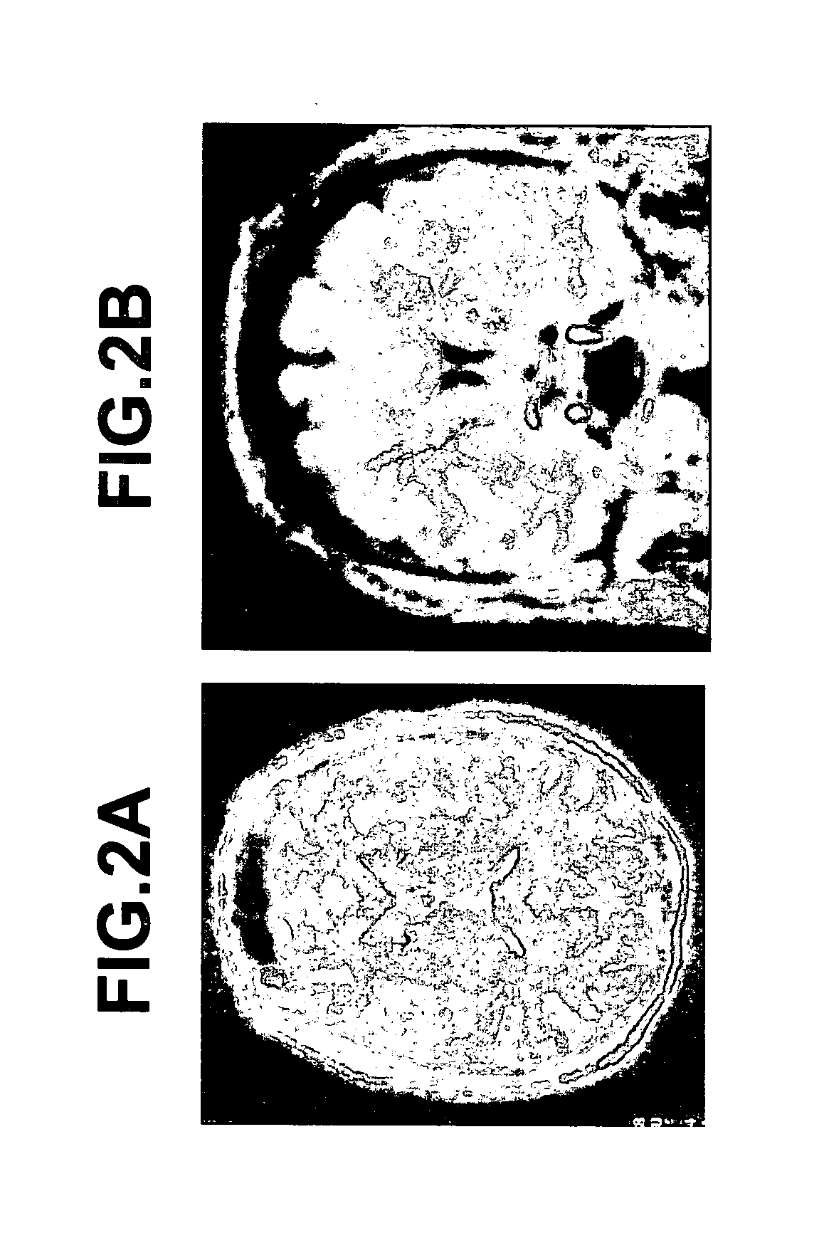 Method for treating obsessive-compulsive disorder with electrical stimulation of the brain internal capsule