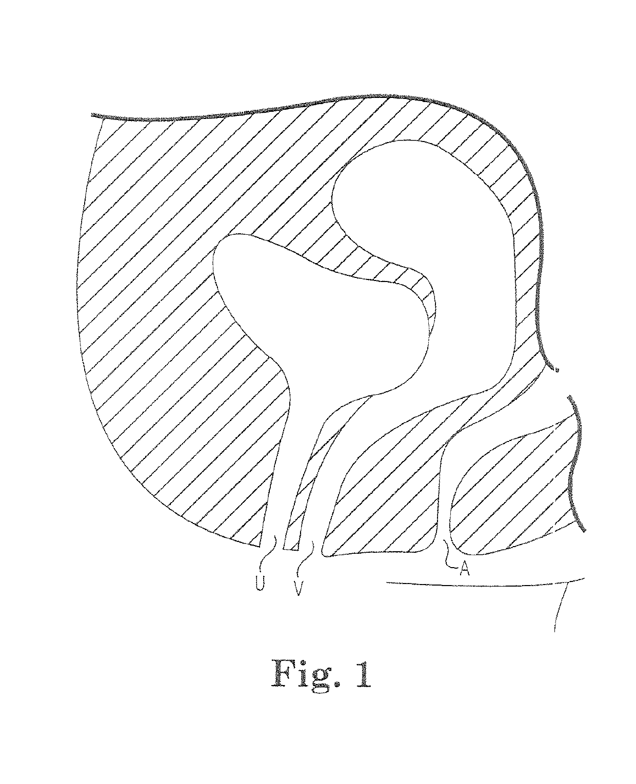 Elongate implant system and method for treating pelvic conditions