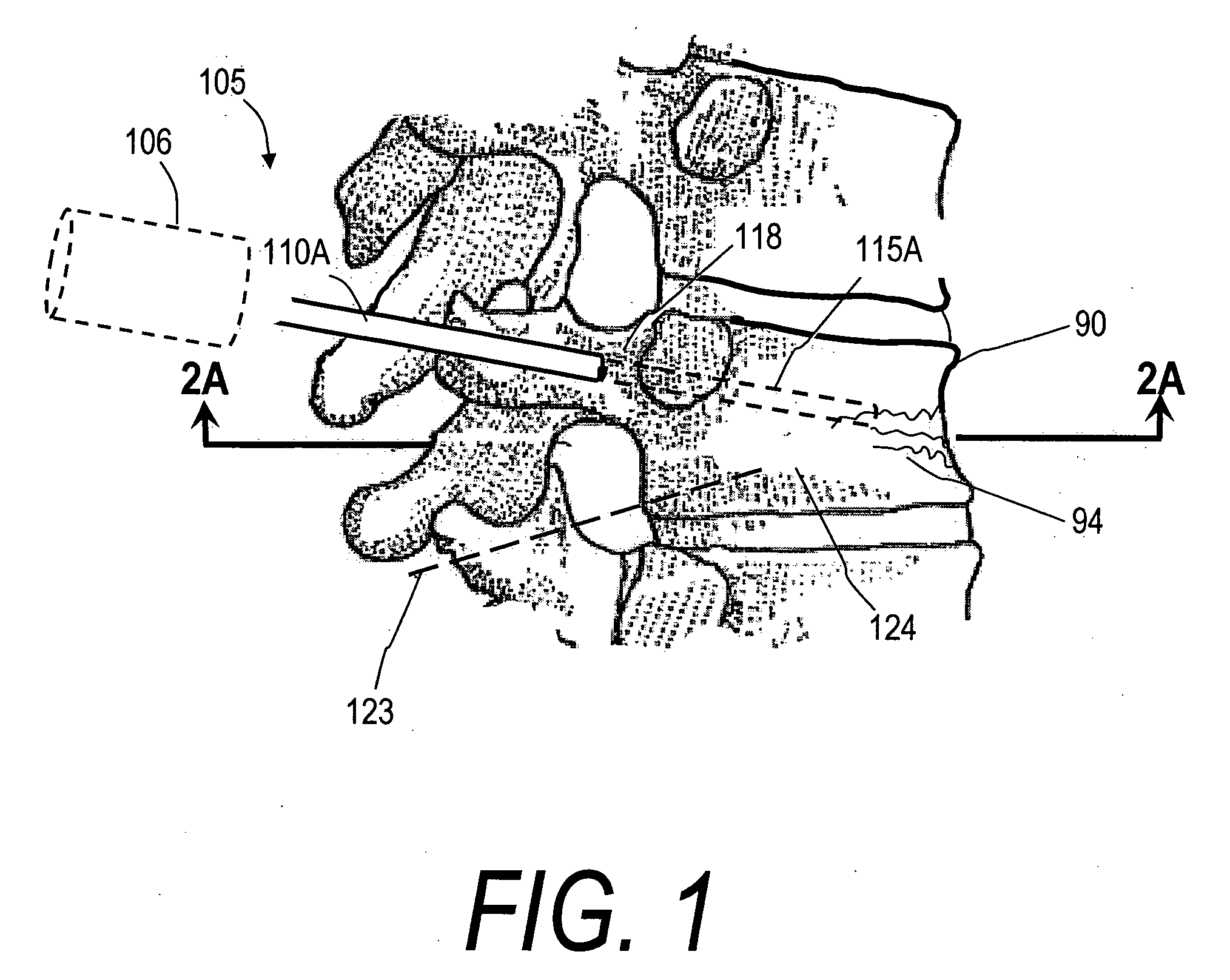 Bone treatment systems and methods