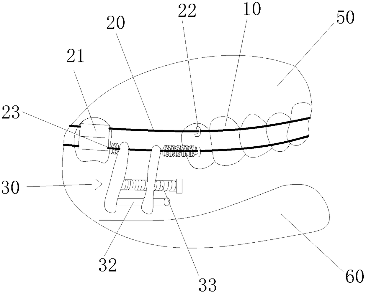 Built-in arc distraction osteogenesis apparatus