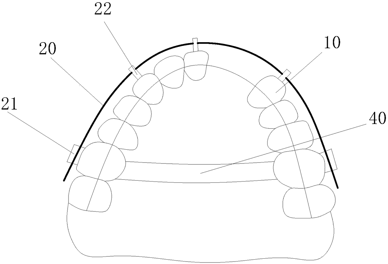 Built-in arc distraction osteogenesis apparatus