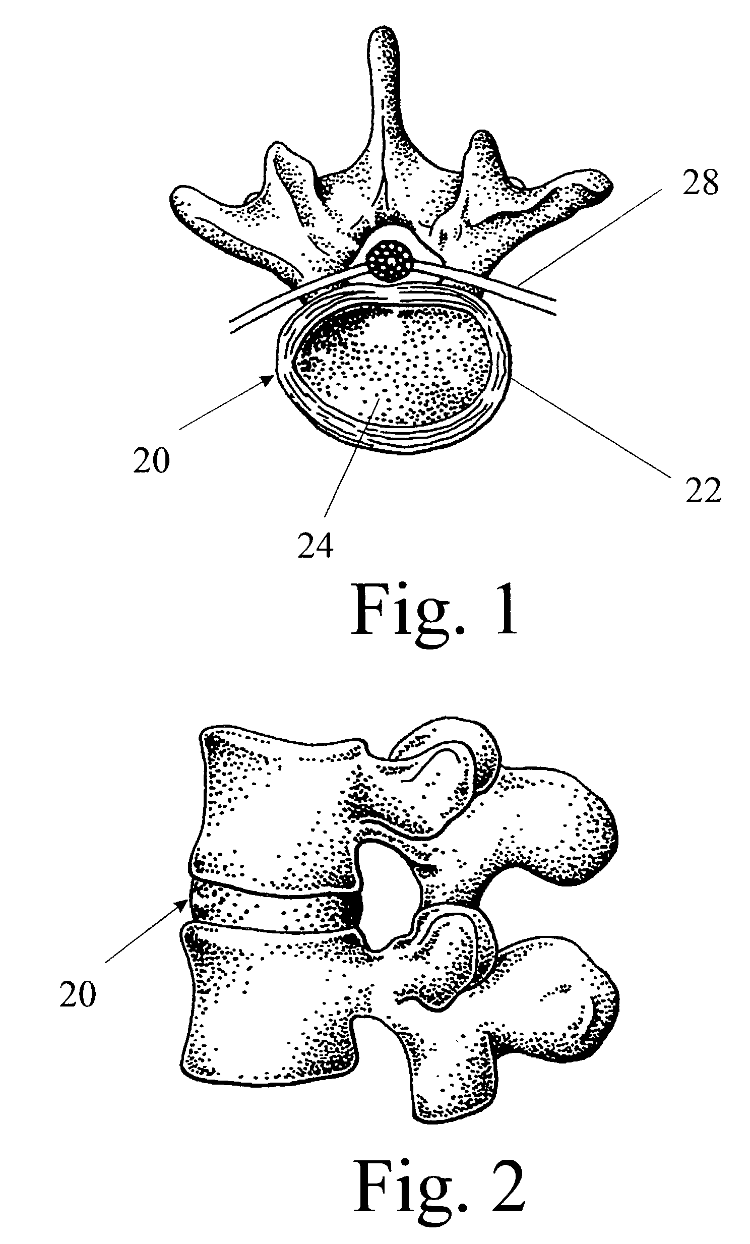 Multiportal device and method for percutaneous surgery