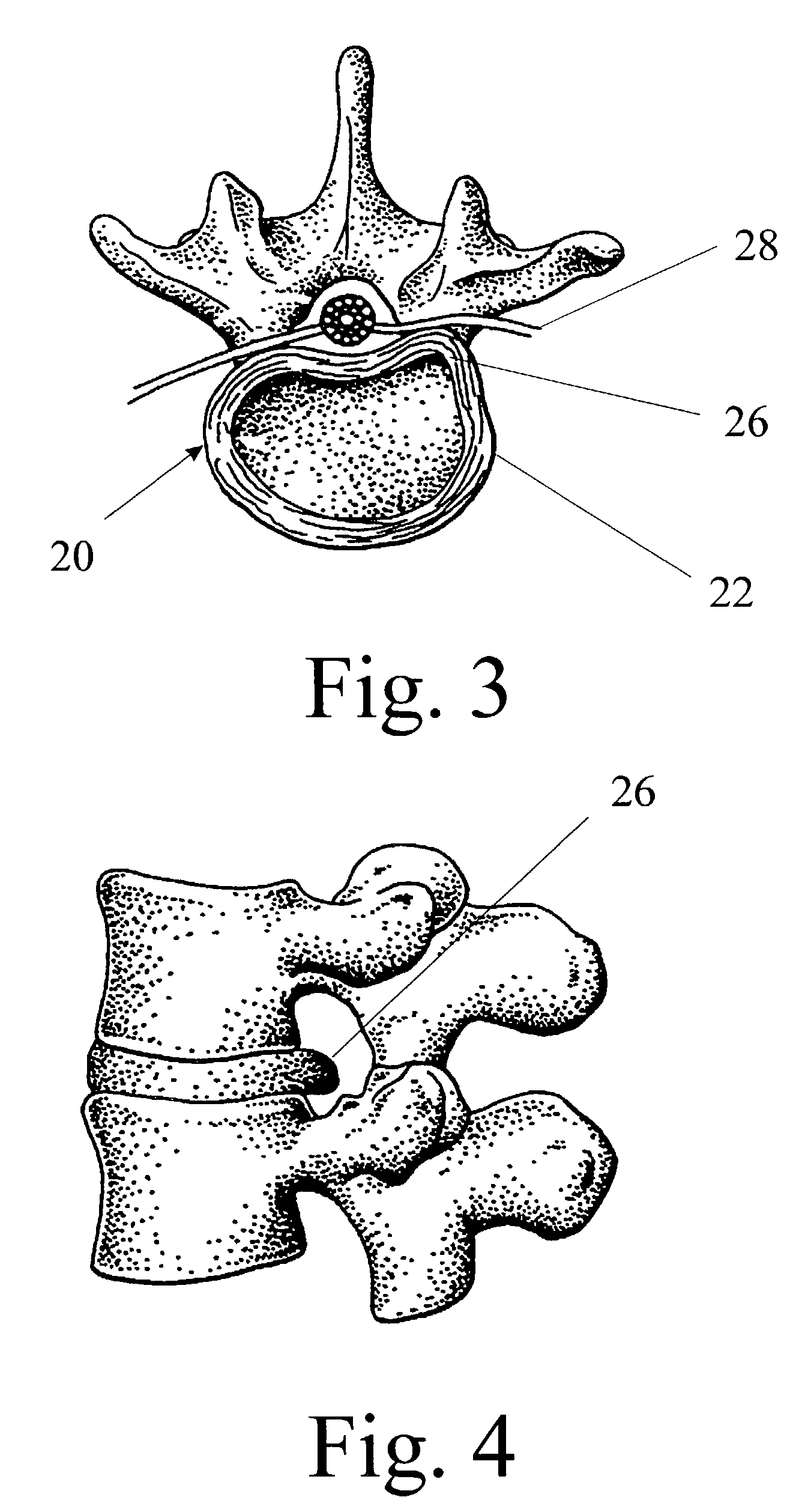 Multiportal device and method for percutaneous surgery