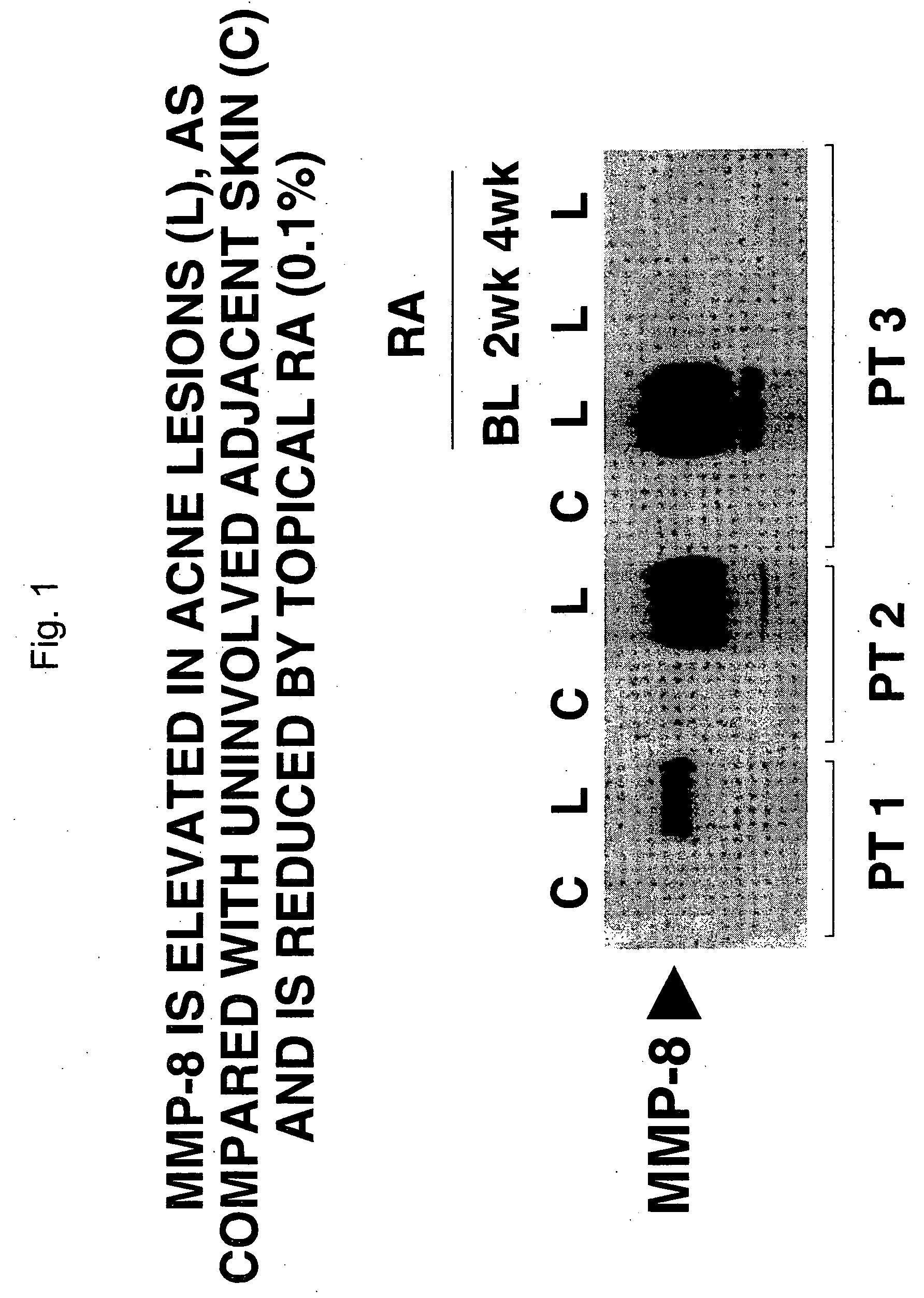 Compositions and methods for use against acne-induced inflammation and dermal matrix-degrading enzymes