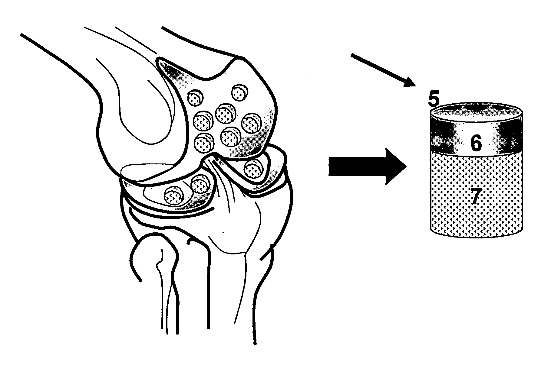 Implantation of Cartilage