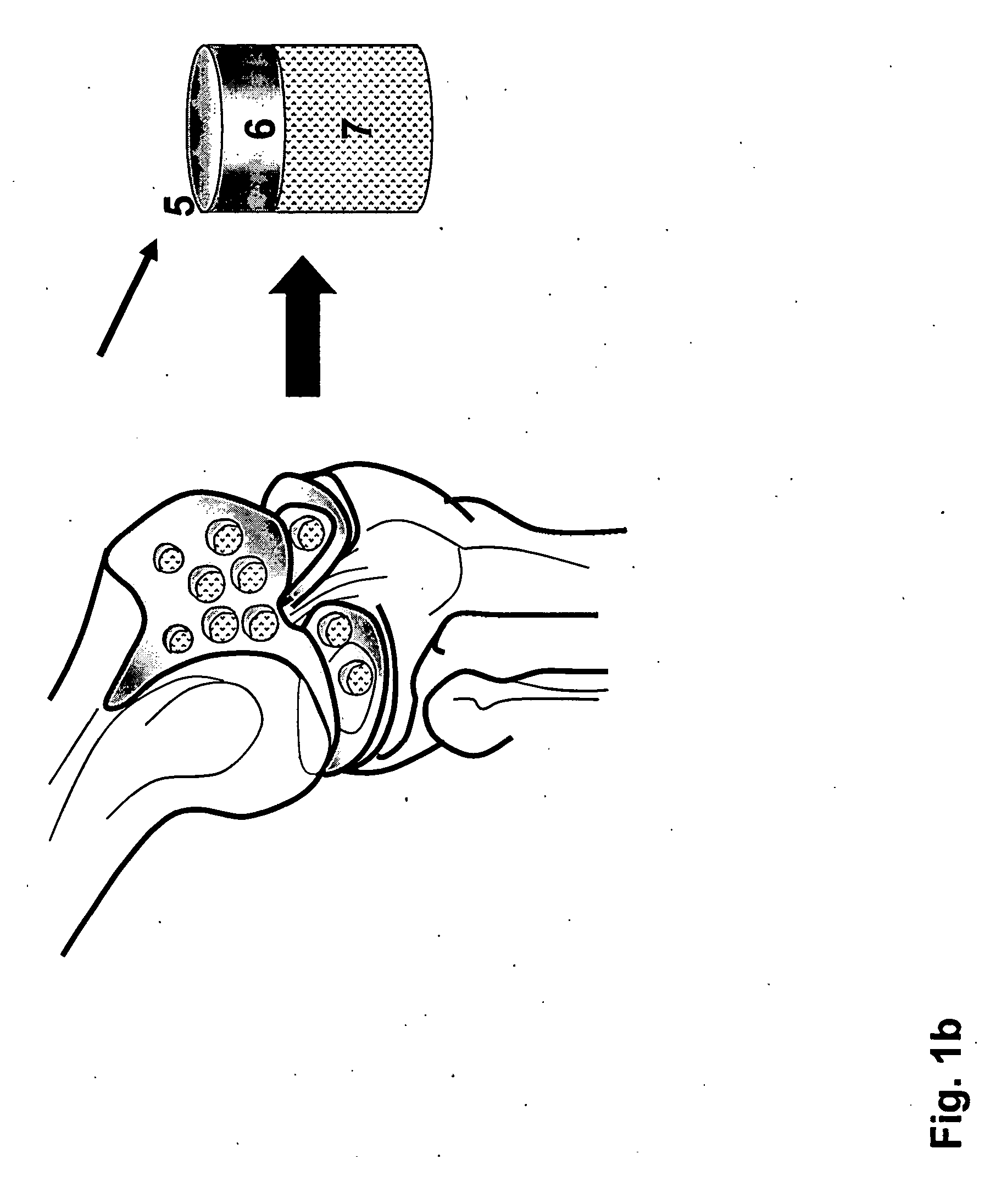 Implantation of Cartilage