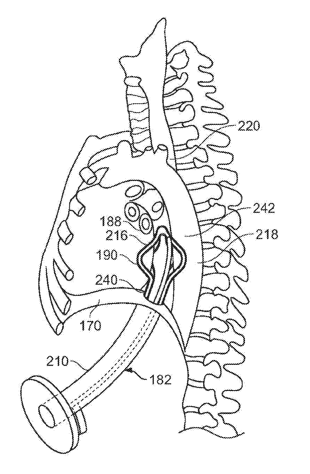 Diaphragm entry for posterior surgical access