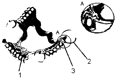 Pure titanium removable denture bracket with vitallium clasp and preparation method thereof