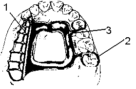 Pure titanium removable denture bracket with vitallium clasp and preparation method thereof