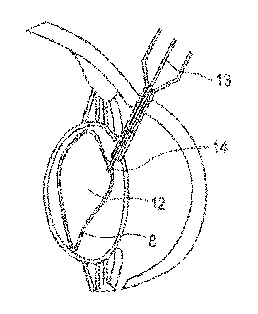 Accommodating intraocular lens