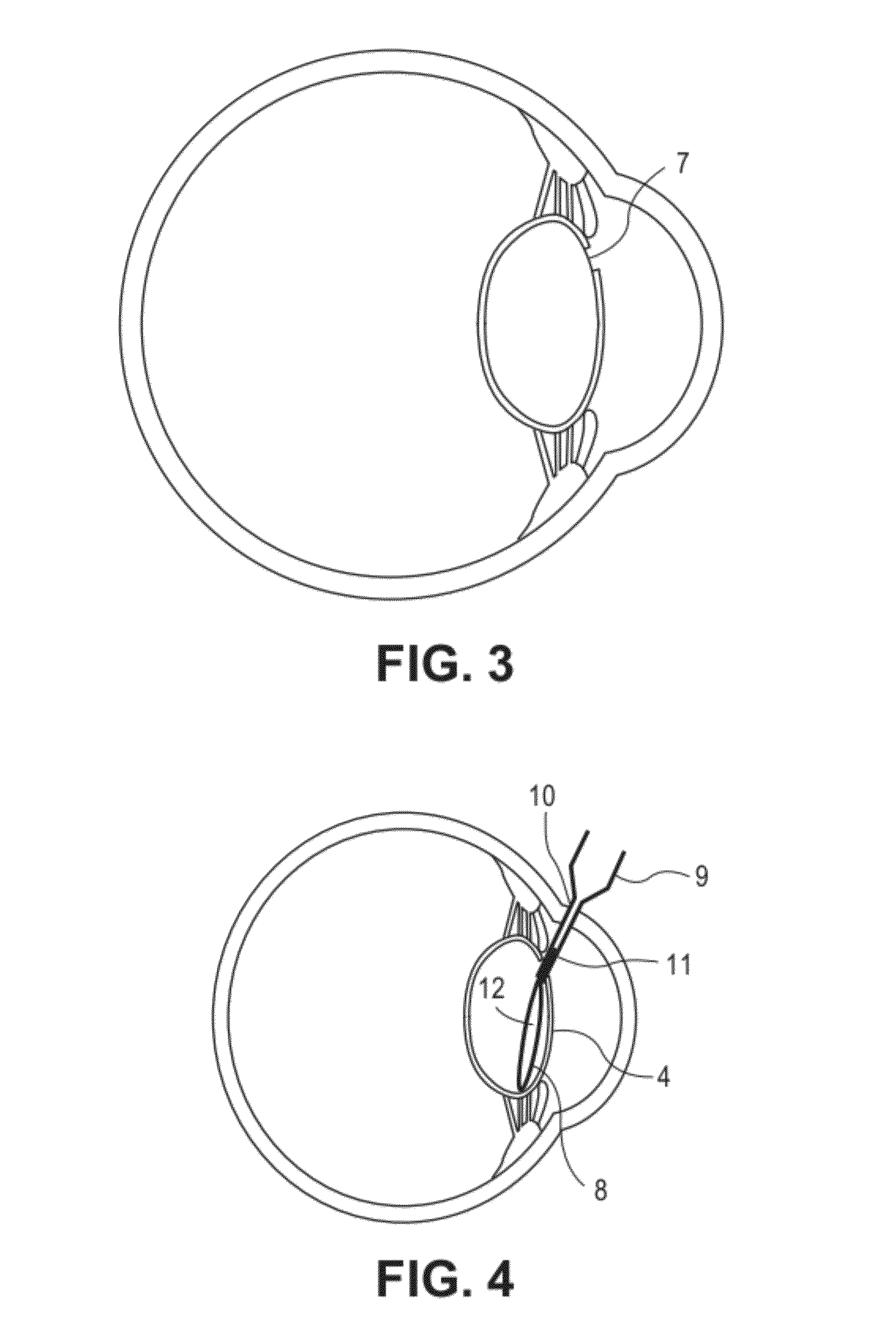 Accommodating intraocular lens