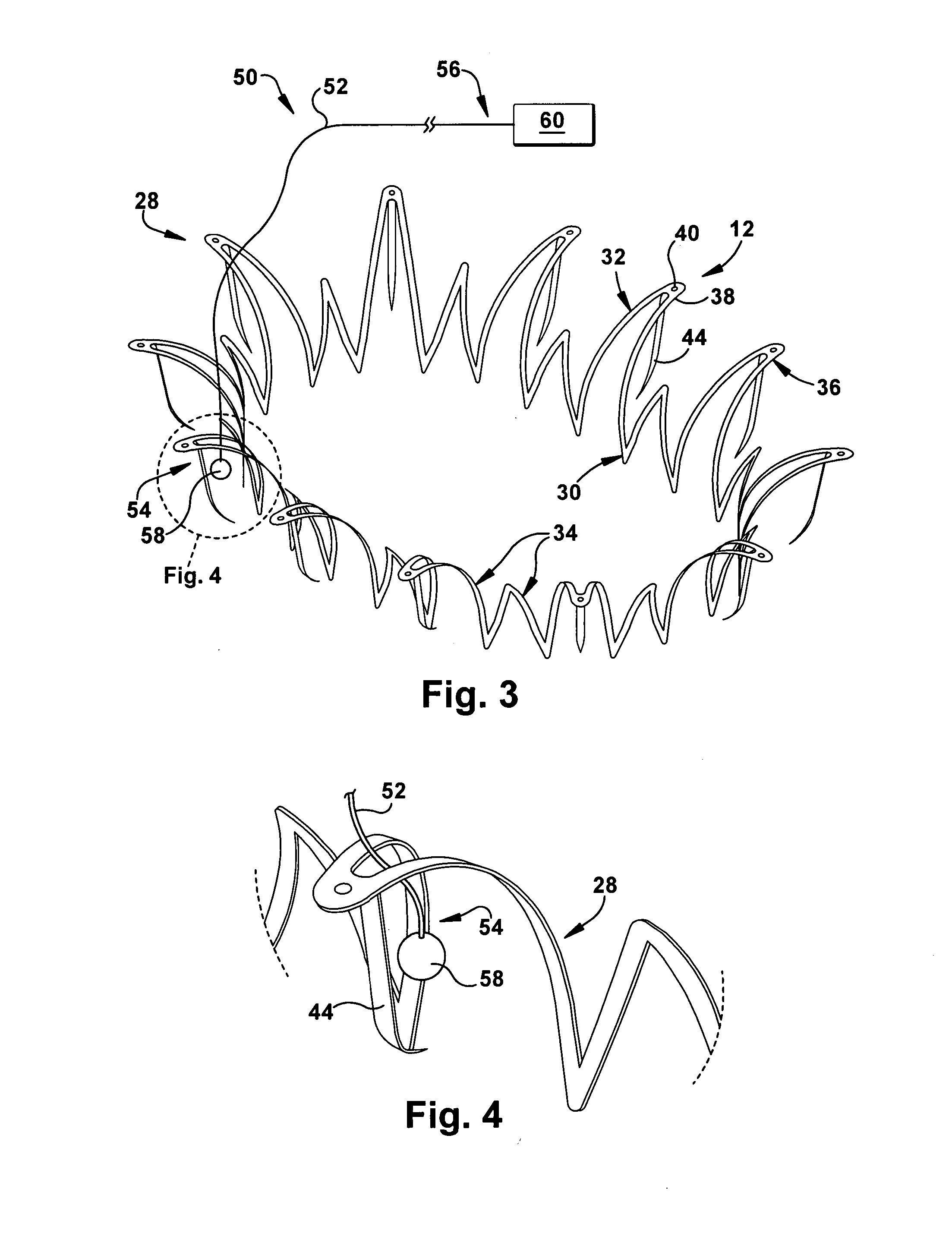 Apparatus and methods for repair of a cardiac valve