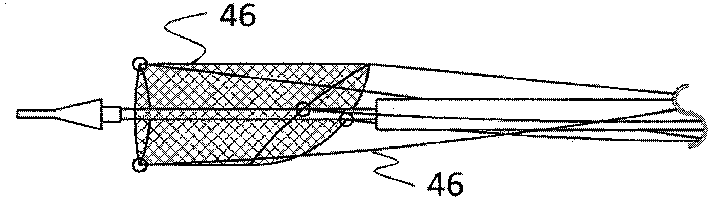 Percutaneous aorta bracket or aortic valve bracket system with far-end protection