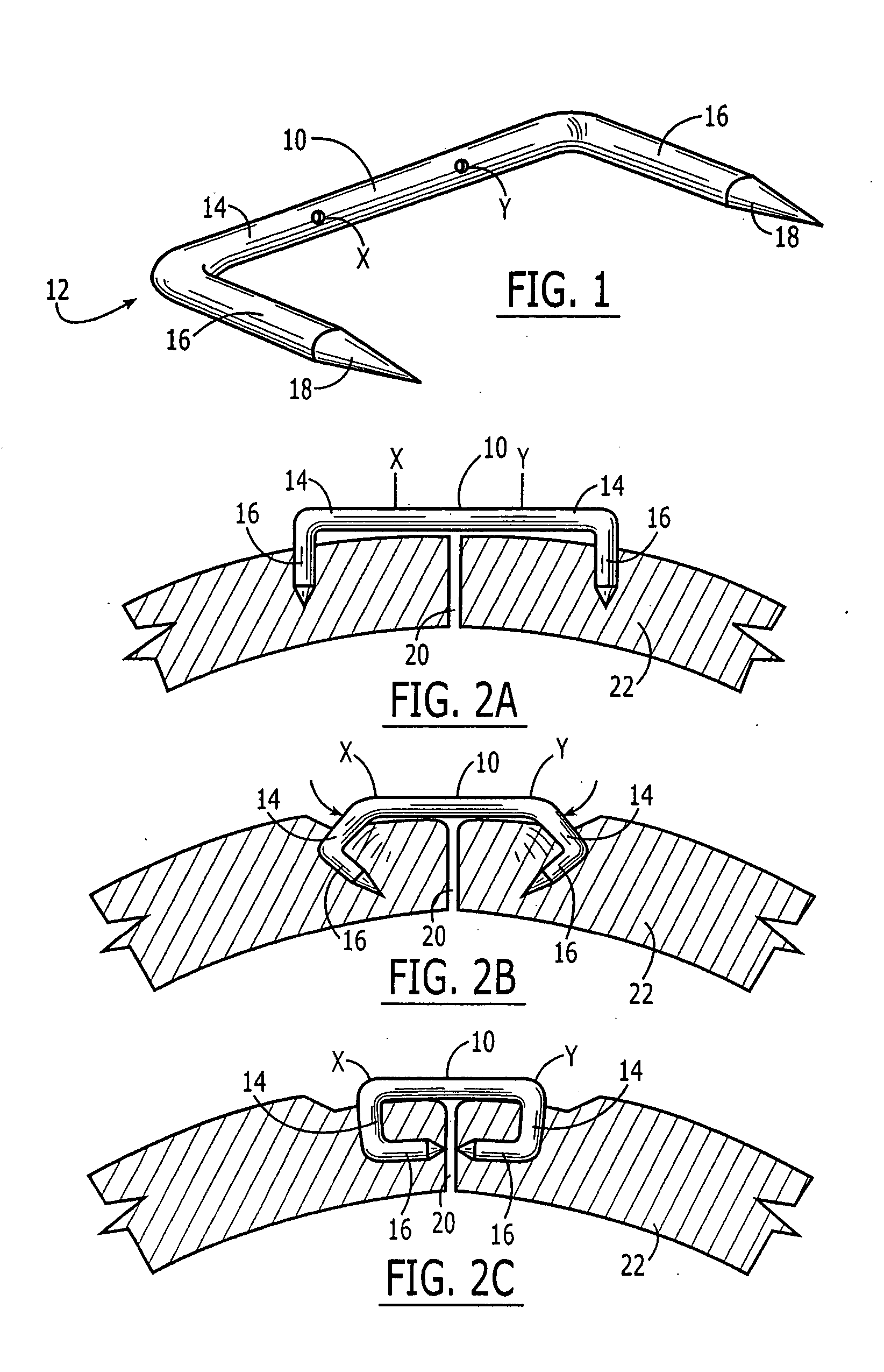 Surgical staple