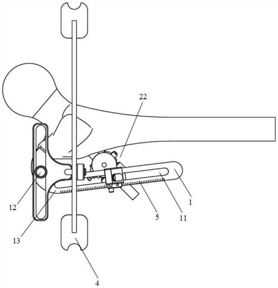 Femoral head external fixation drilling support