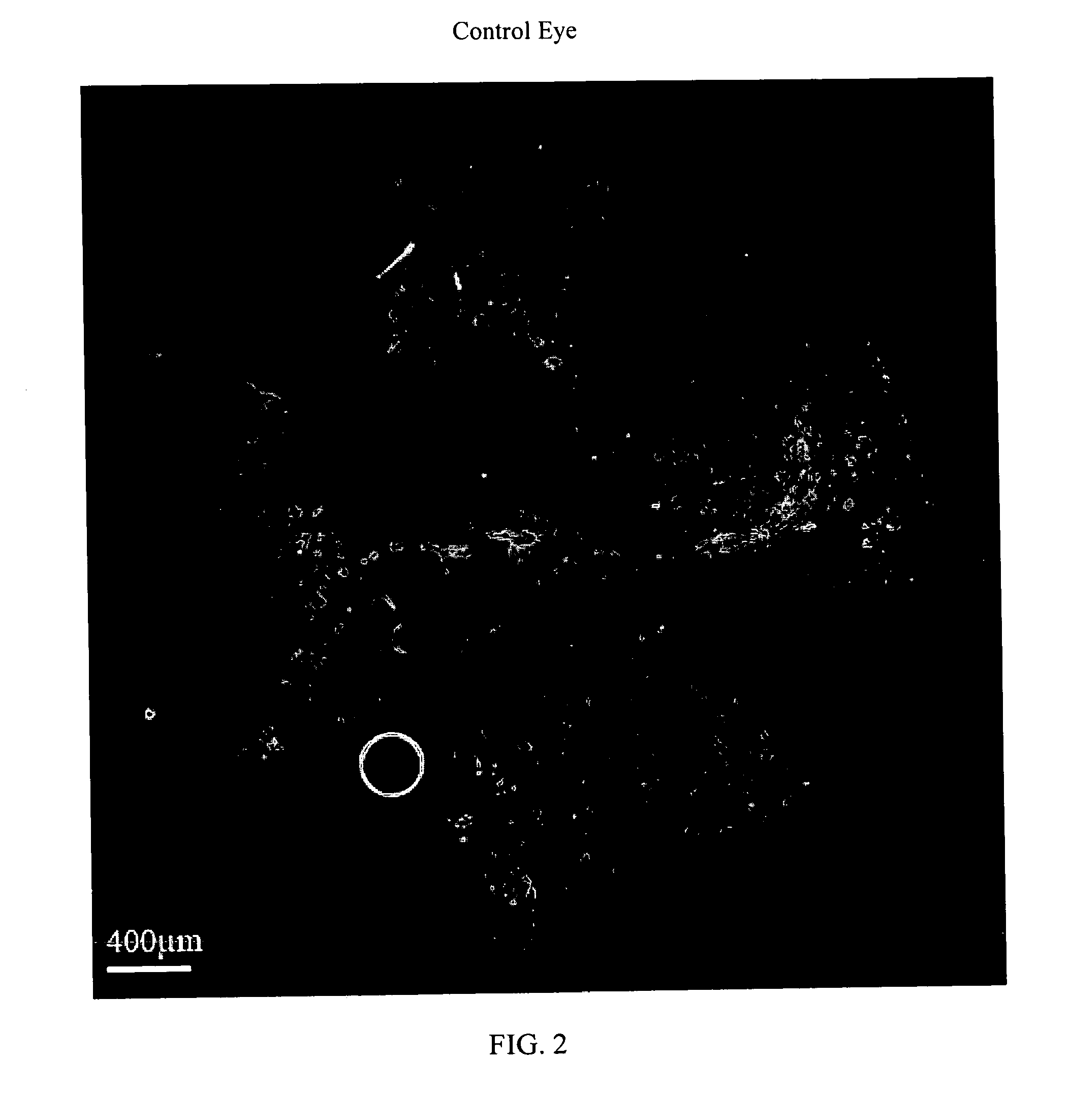 Method For The Treatment Of Proliferative Disorders Of The Eye