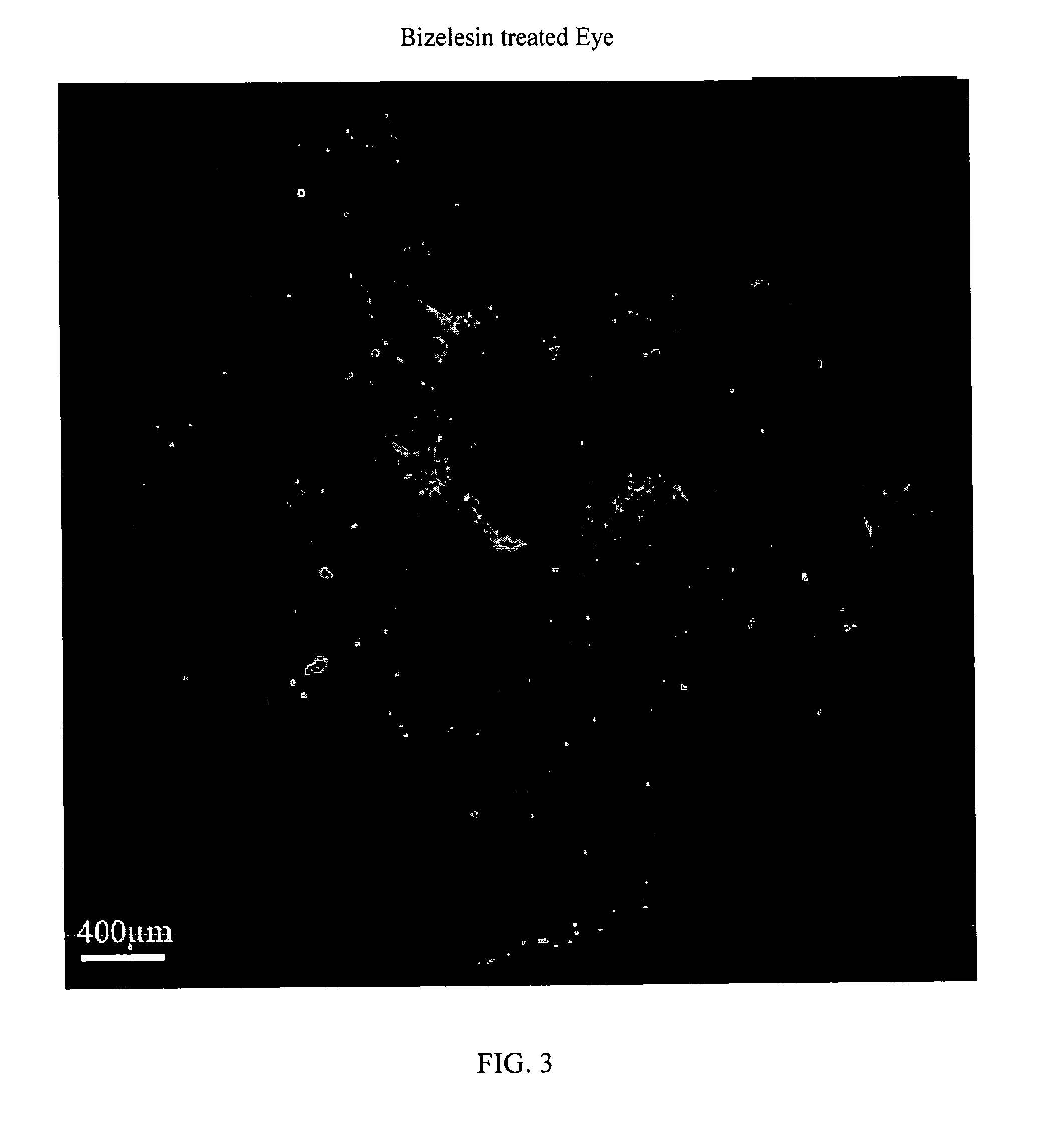 Method For The Treatment Of Proliferative Disorders Of The Eye