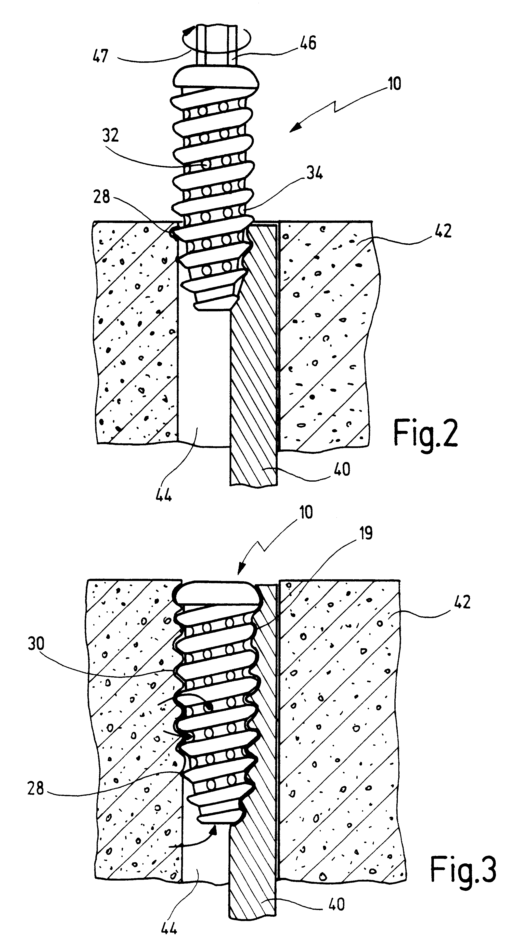 Biodegradable fixation element