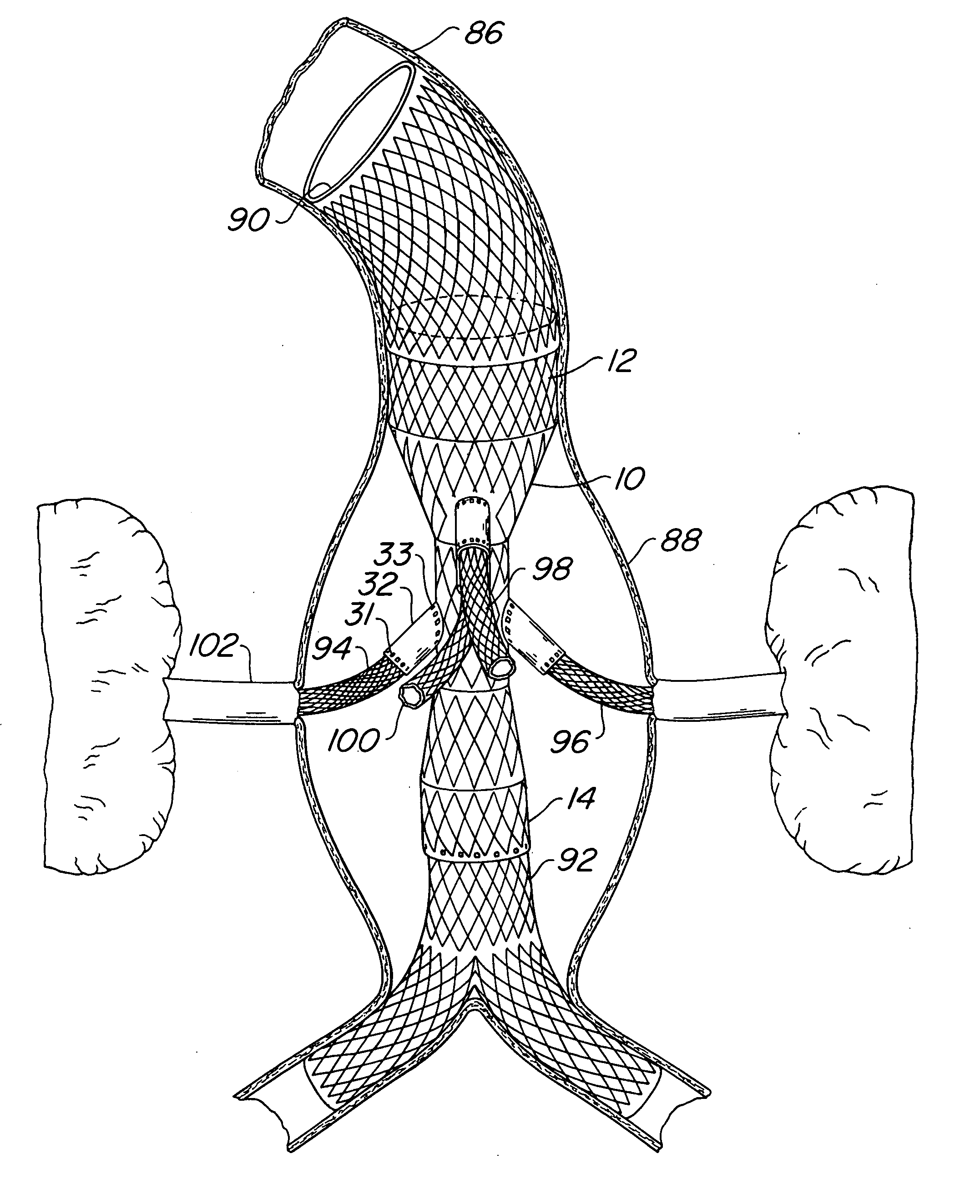 Endovascular prosthesis, system and method