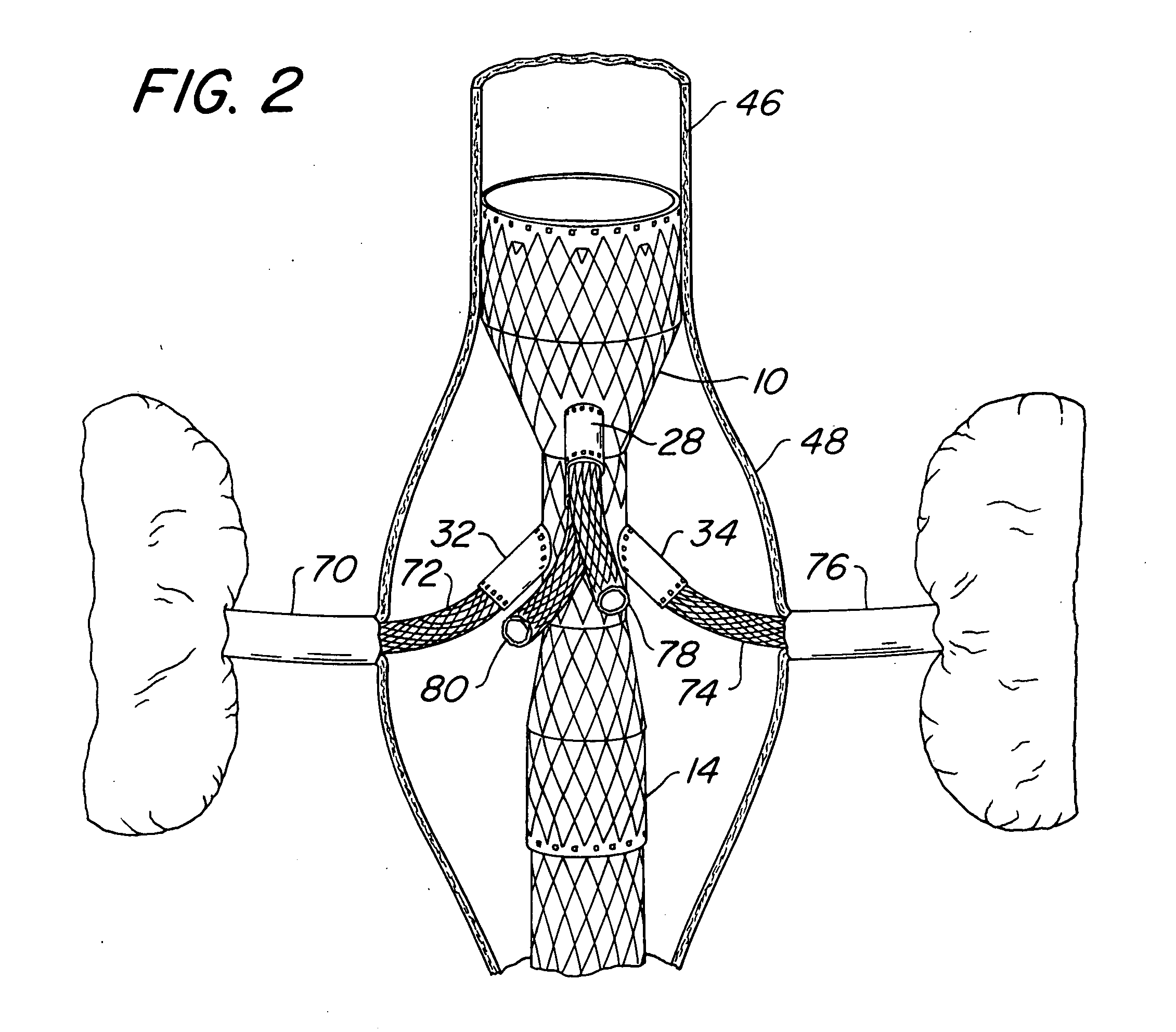 Endovascular prosthesis, system and method