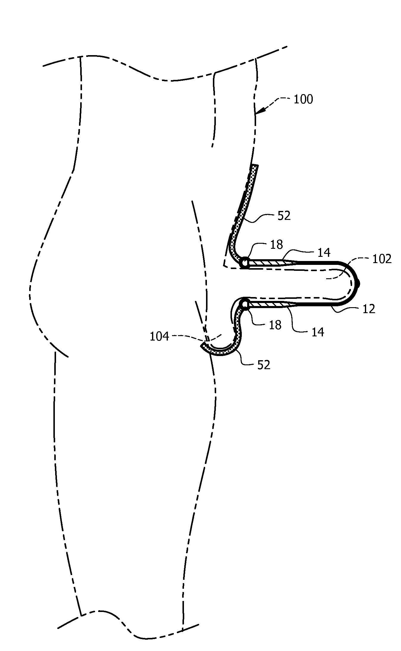 Sexually transmitted disease shield and condom