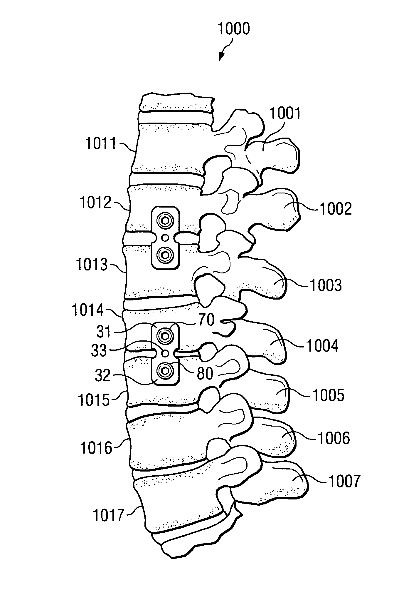 Bone alignment implant and method of use