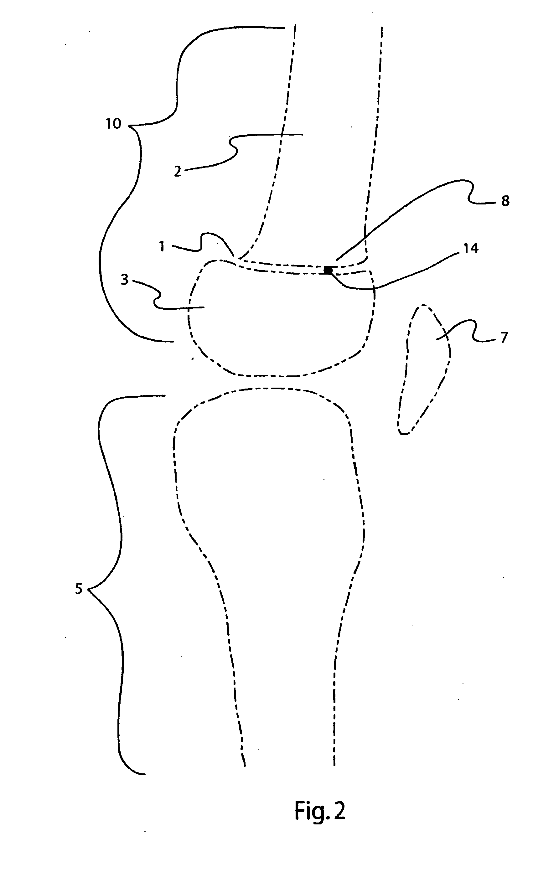 Bone alignment implant and method of use