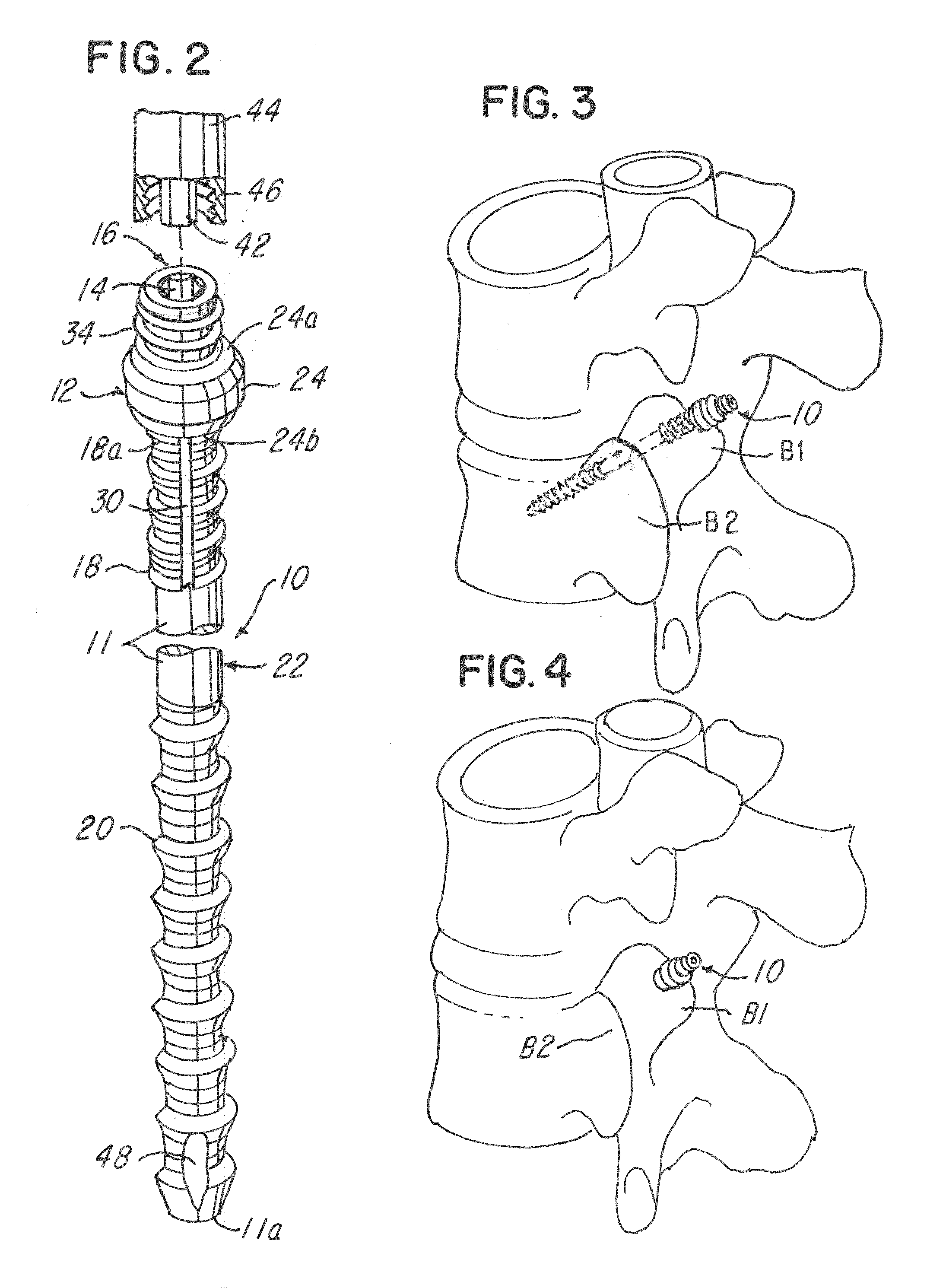 Minimally invasive spinal facet compression screw and system for bone joint fusion and fixation