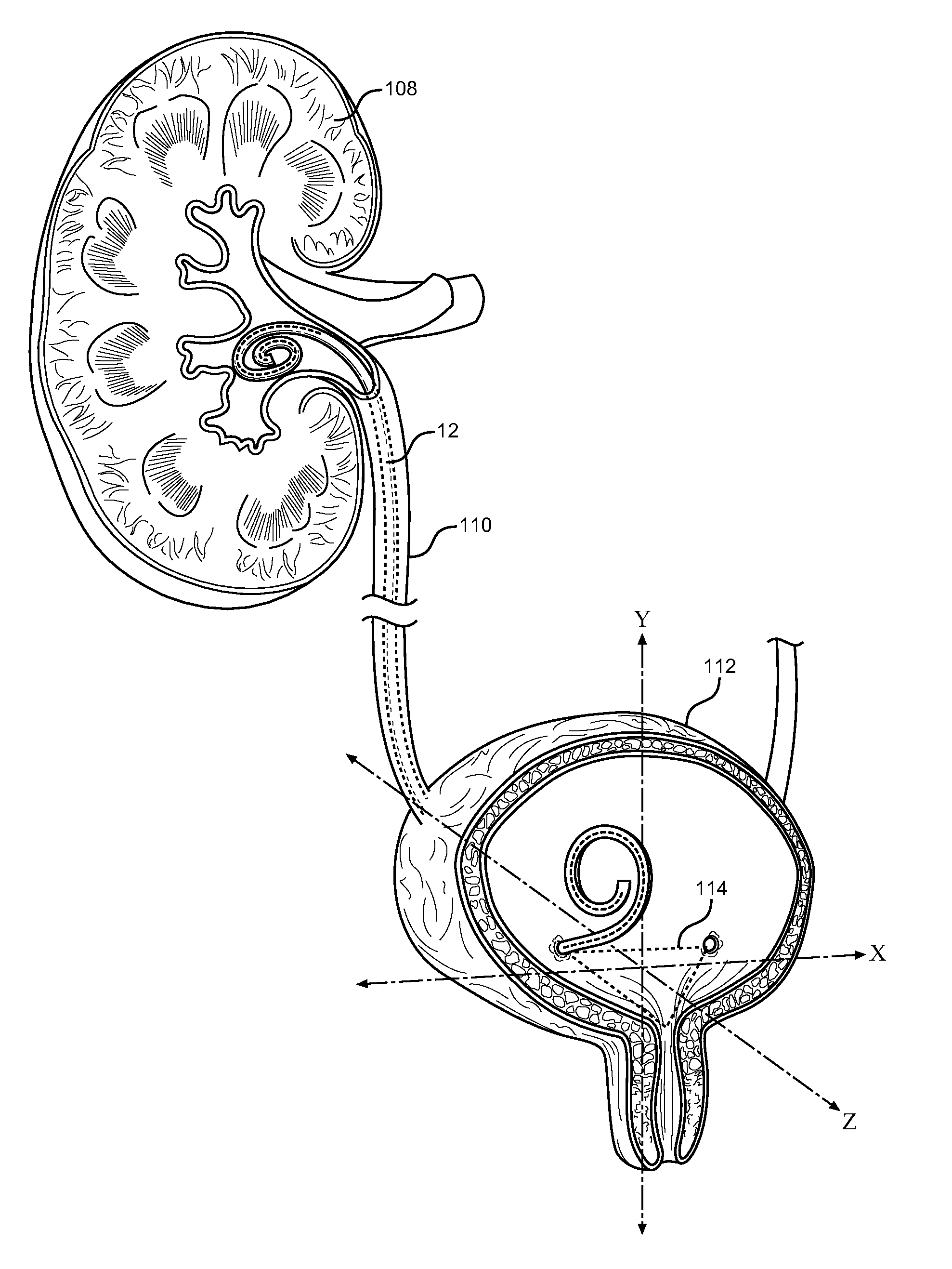 Anti-Refluxive and Trigone Sparing Internal Ureteral Stent