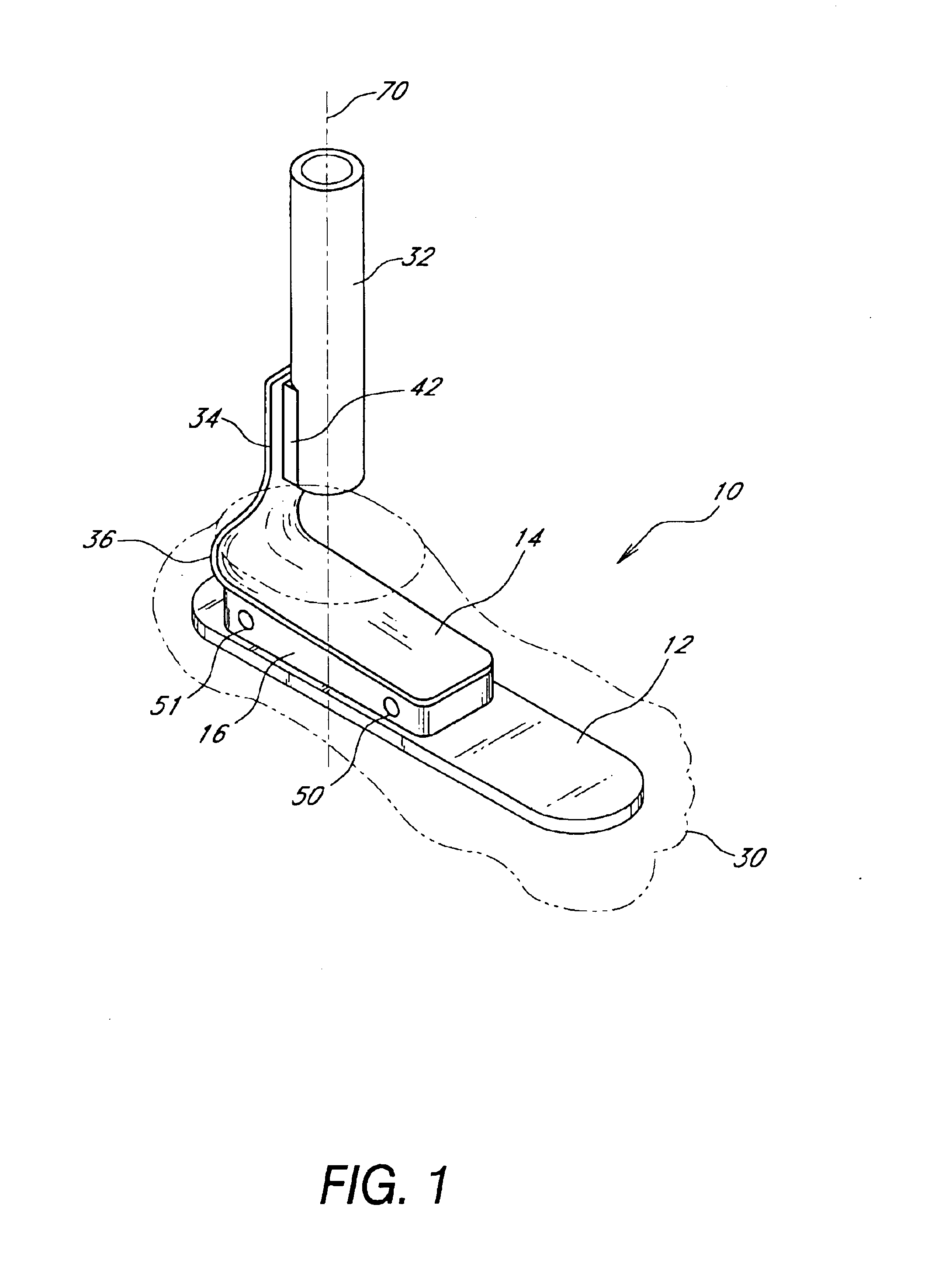 Foot prosthesis having cushioned ankle