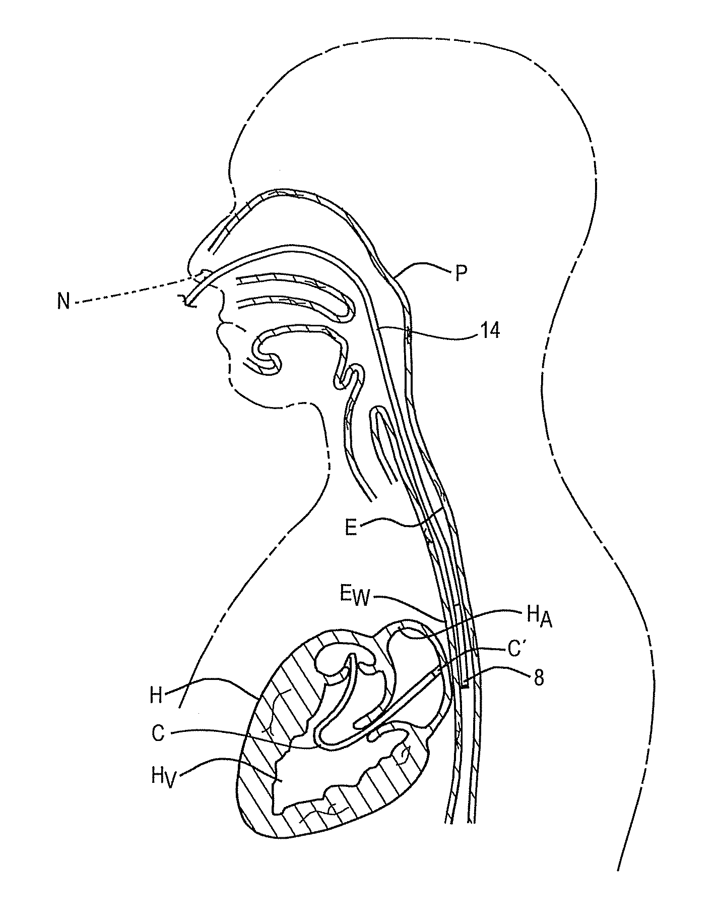 Method and apparatus for minimizing thermal trauma to an organ during tissue ablation of a different organ