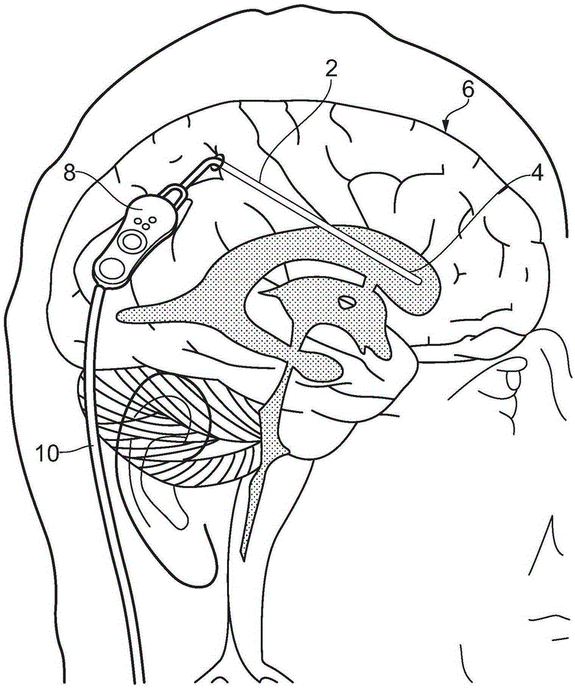 neurosurgical equipment