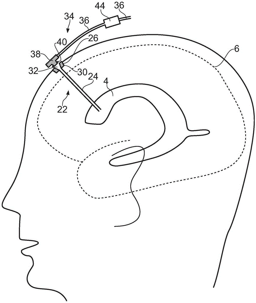 neurosurgical equipment