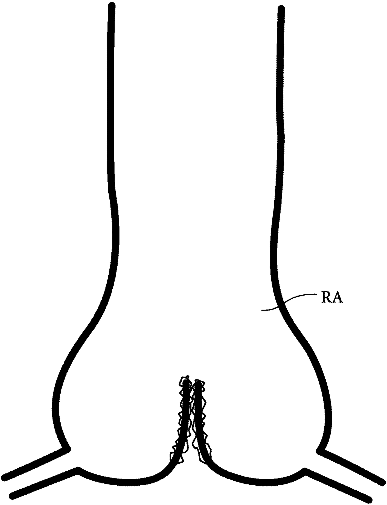 Device for transcatheter insertion into the aortic root at the sinotubular junction