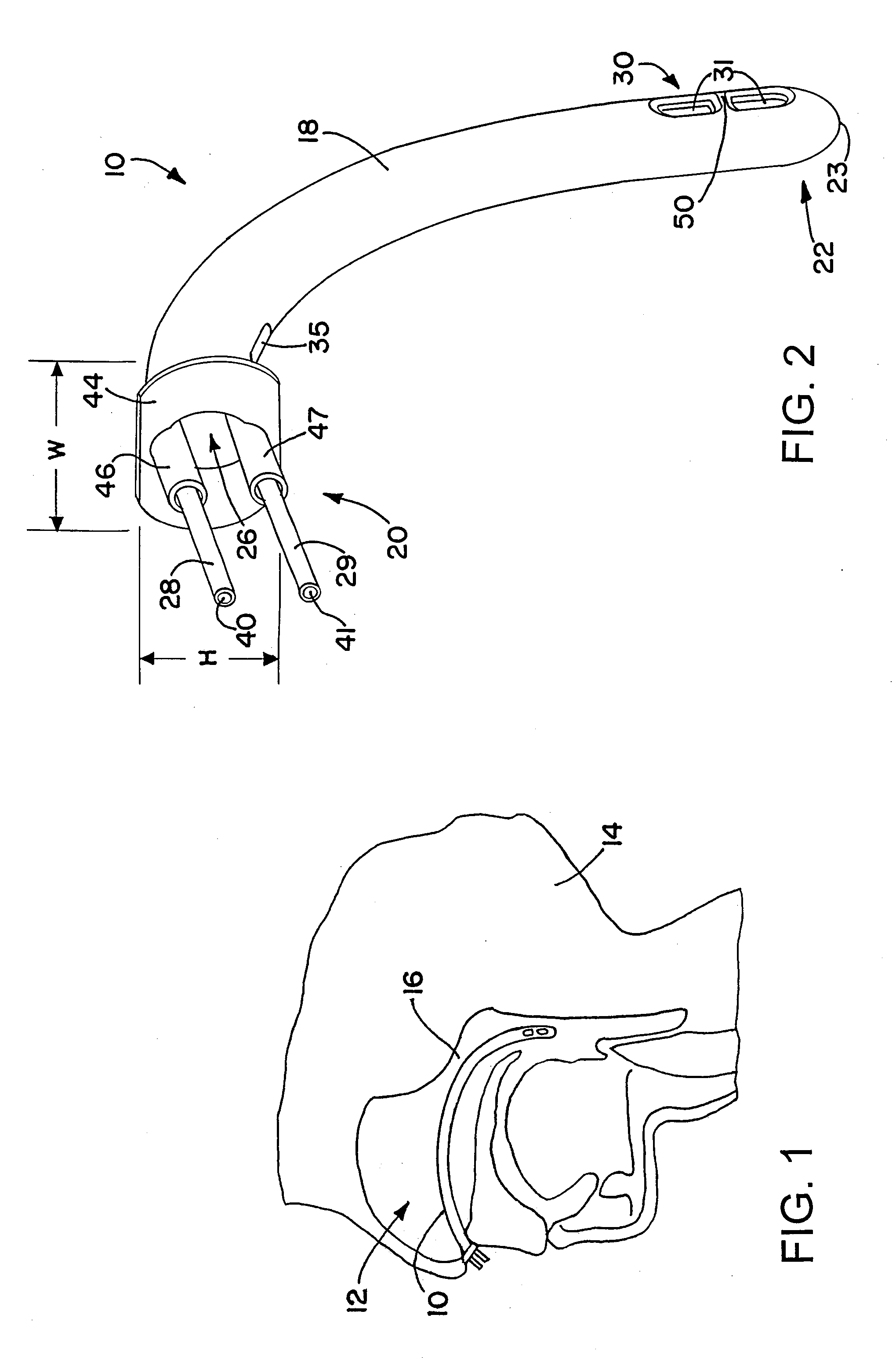 Nasopharyngeal airway