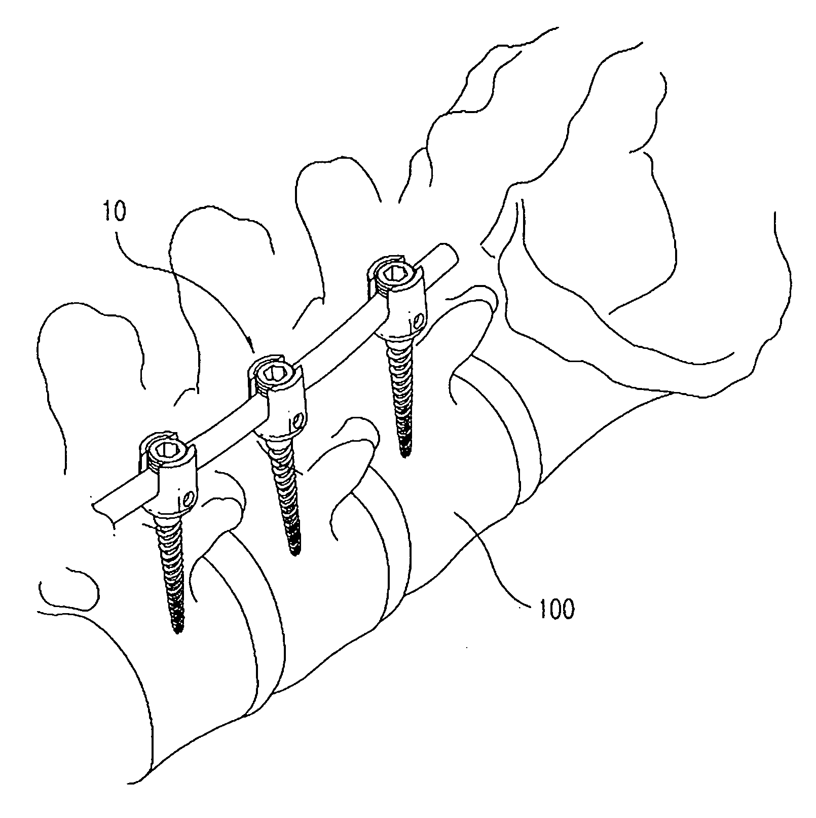 Buffer type vertebral pedicle screw