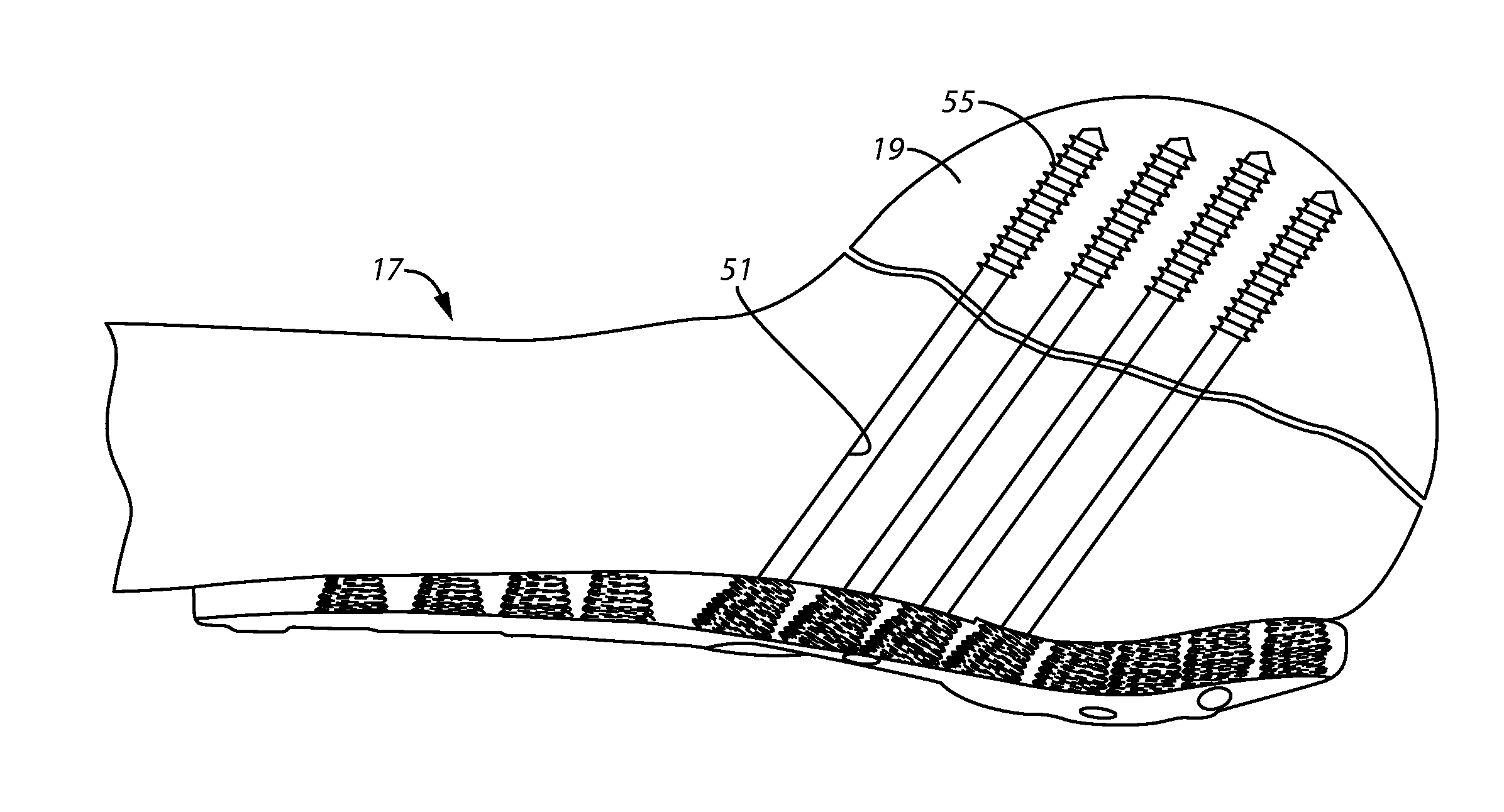 Bone plate system for repair of proximal humeral fracture