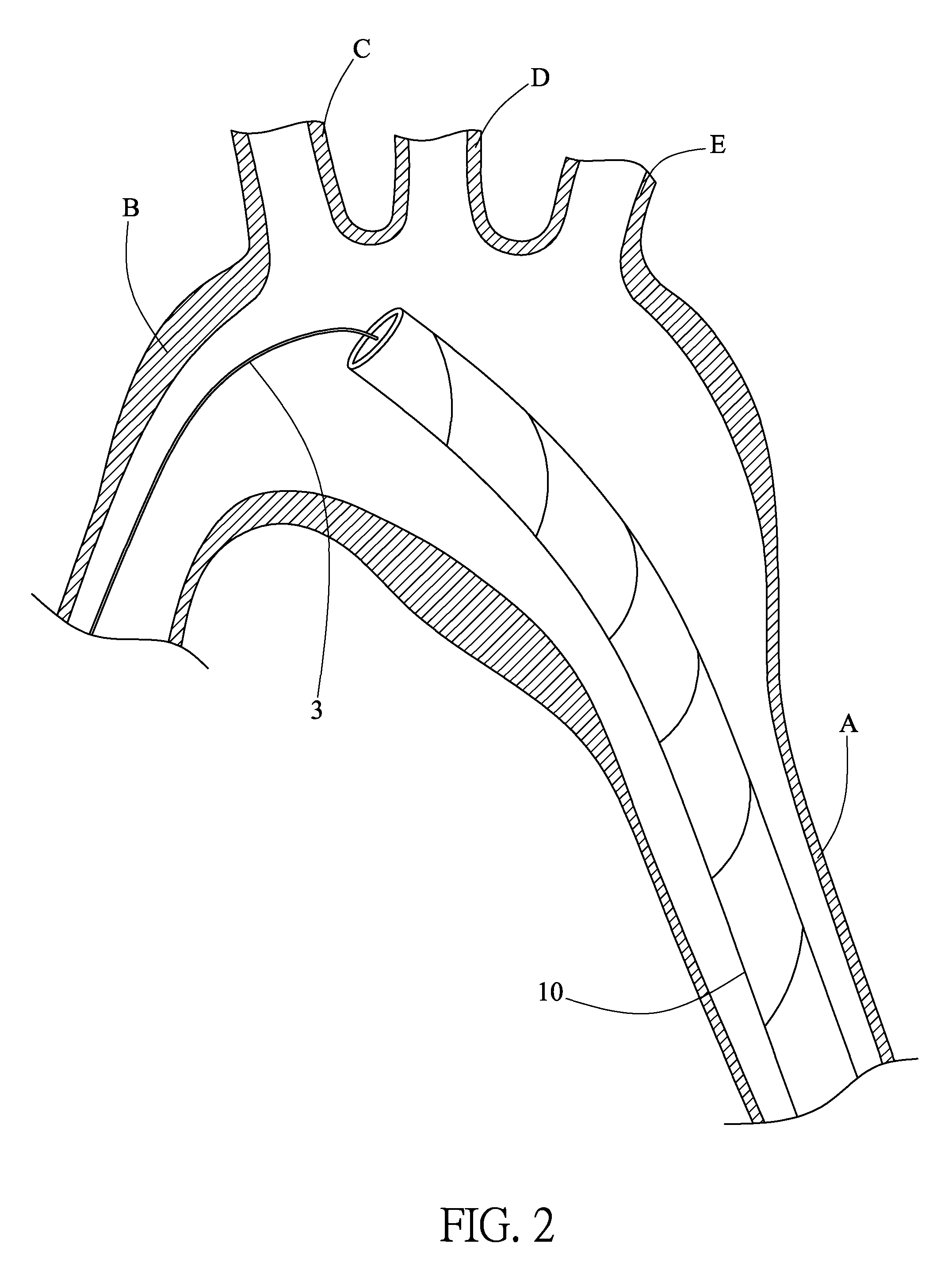 Method of implanting an aortic stent