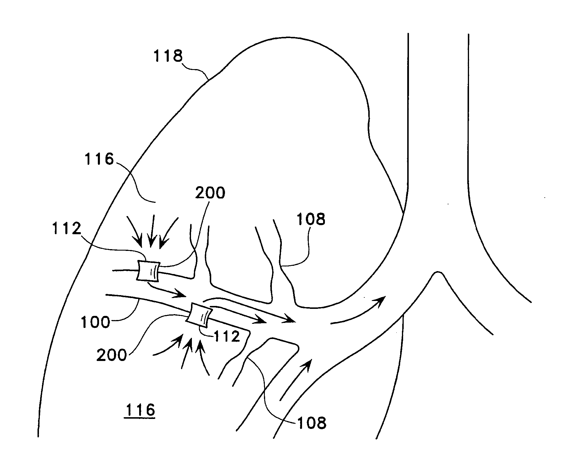 Methods for treating chronic obstructive pulmonary disease